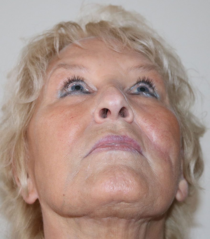 scar revision with fat grafting patient 1 after worms eye view