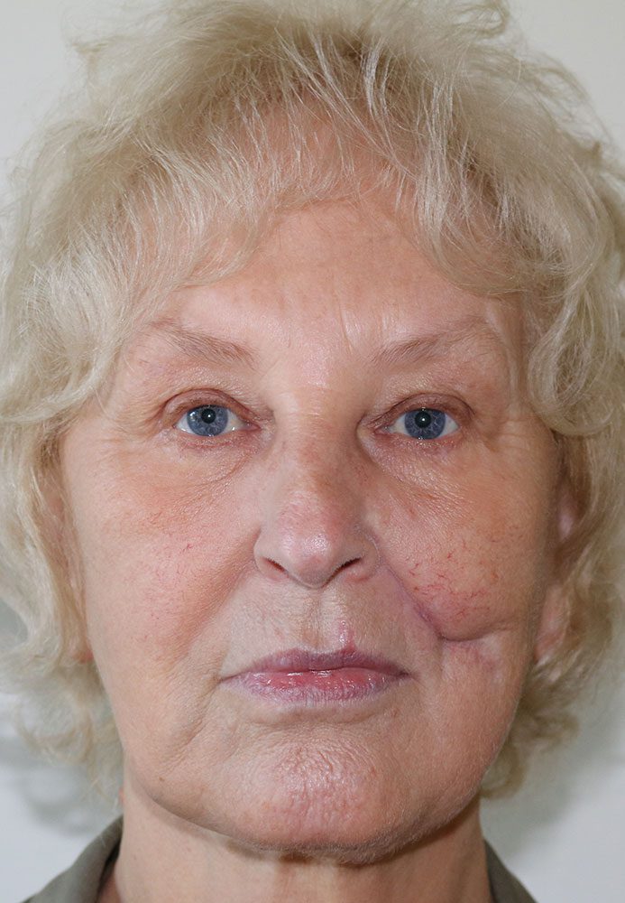 scar revision with fat grafting patient 1 before AP view