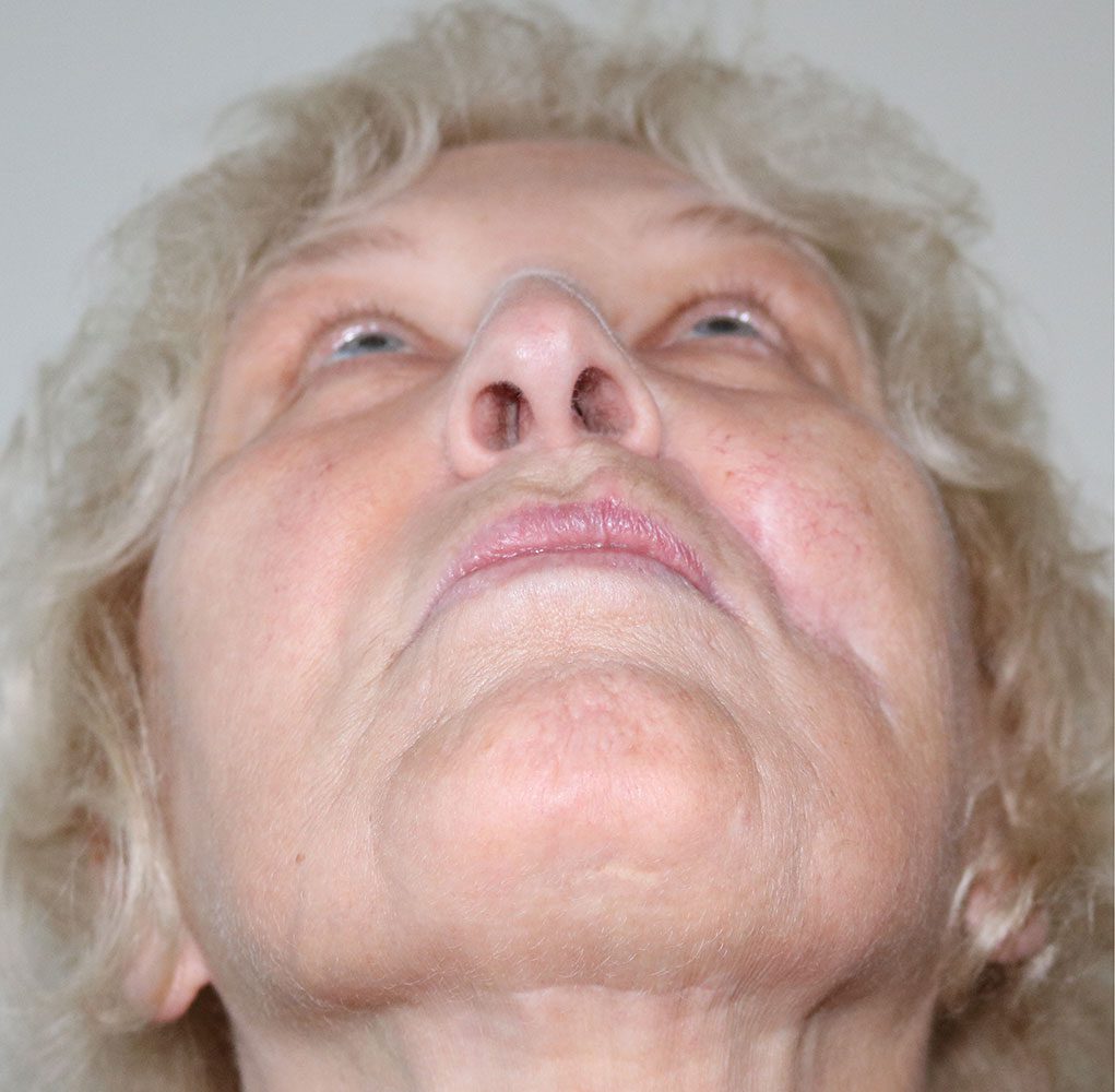scar revision with fat grafting patient 1 before worms eye view