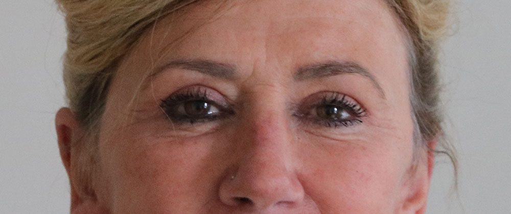 upper blepharoplasty patient 1 after AP view