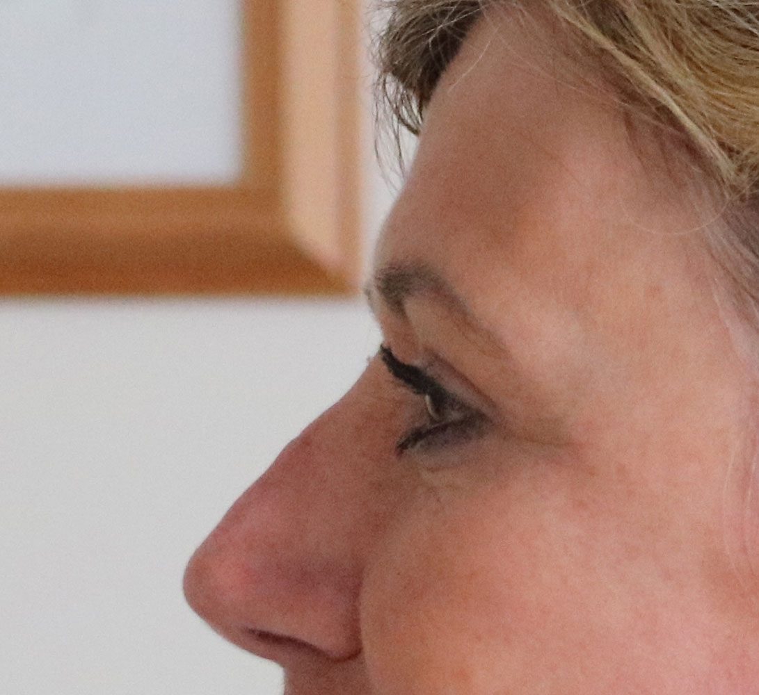upper blepharoplasty patient 1 after leftlateral