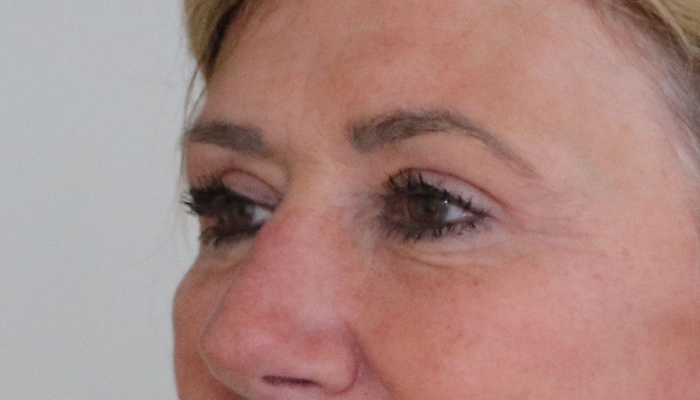 upper blepharoplasty patient 1 after leftoblique