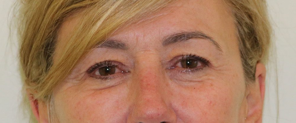 upper blepharoplasty patient 1 before AP view