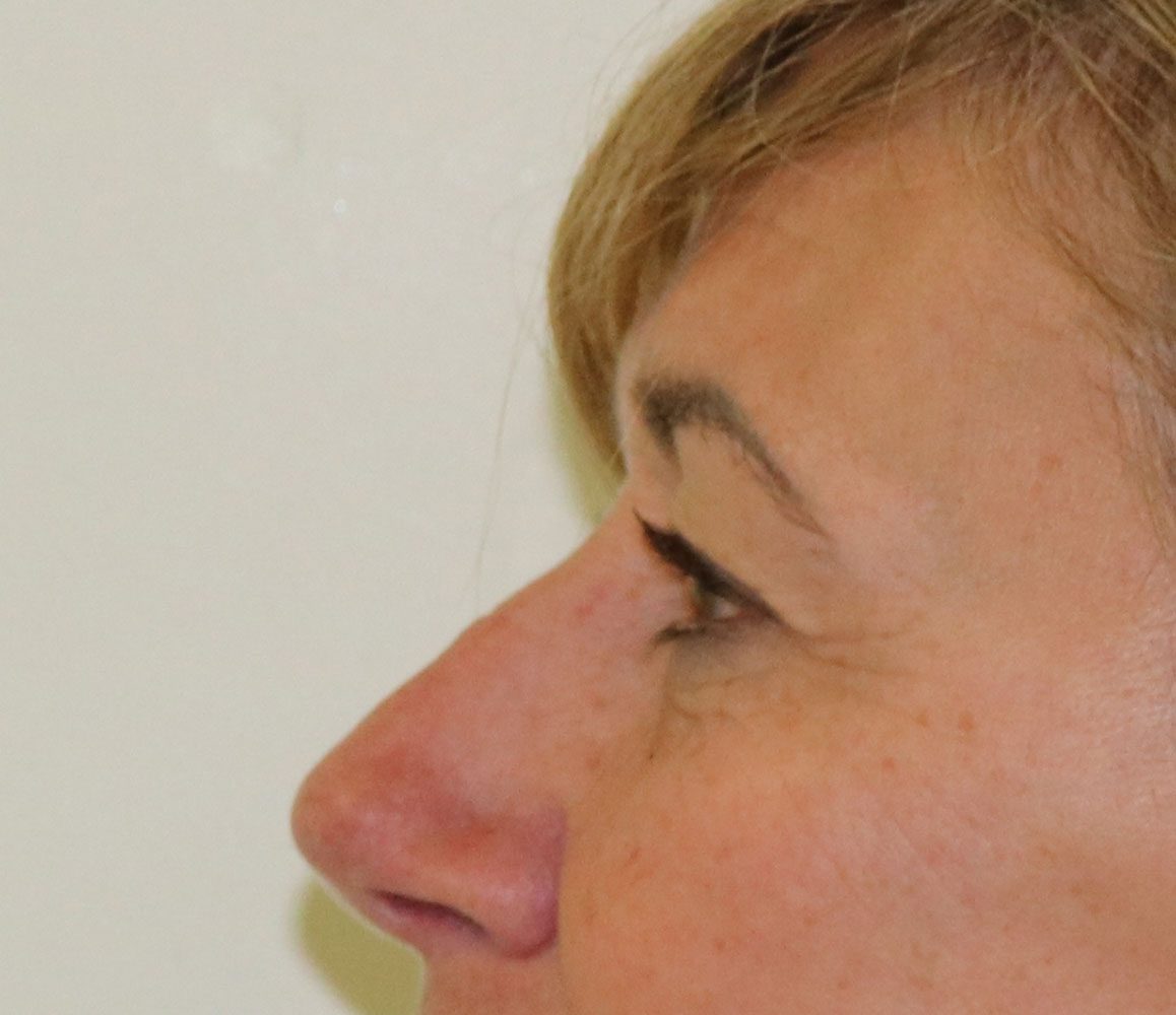 upper blepharoplasty patient 1 before leftlateral