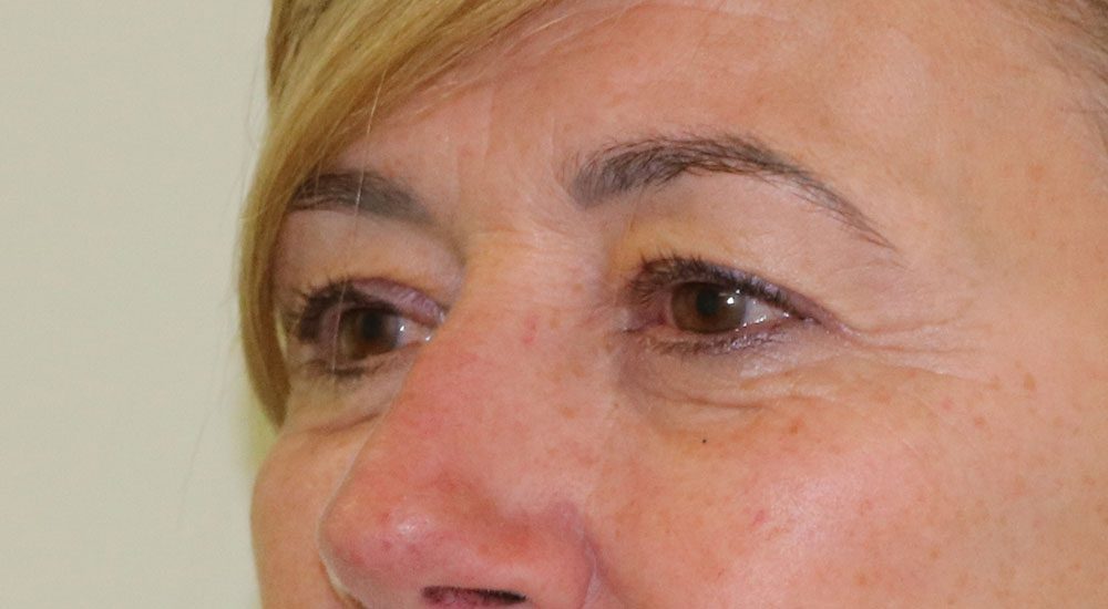 upper blepharoplasty patient 1 before leftoblique