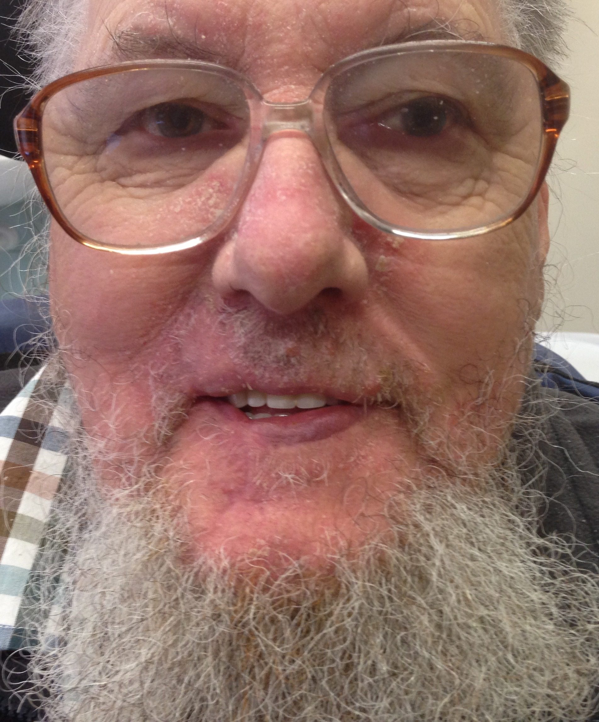Abbe flap upper lip reconstruction patient 1 after AP view