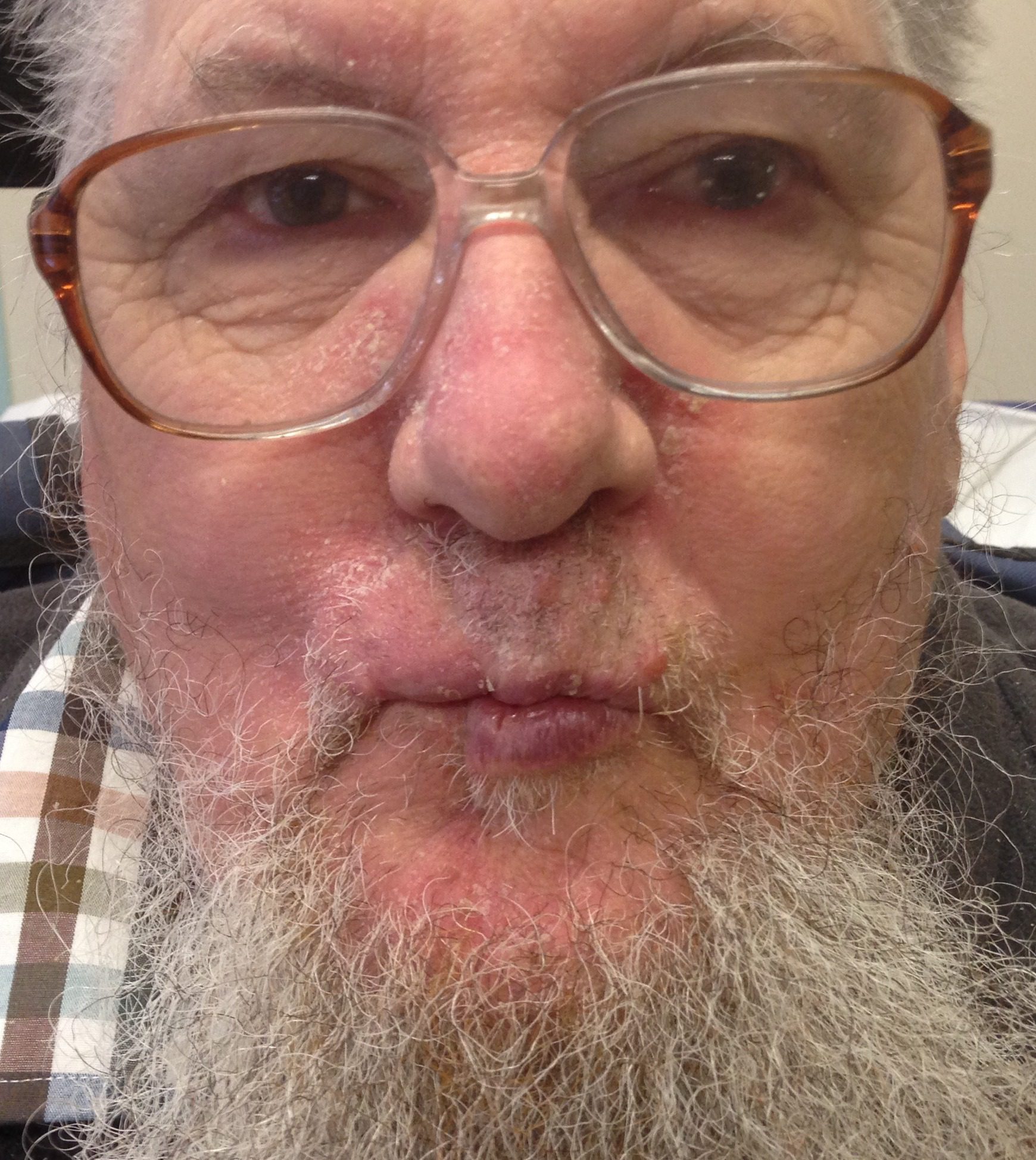 Abbe flap upper lip reconstruction patient 1 after lips pursed