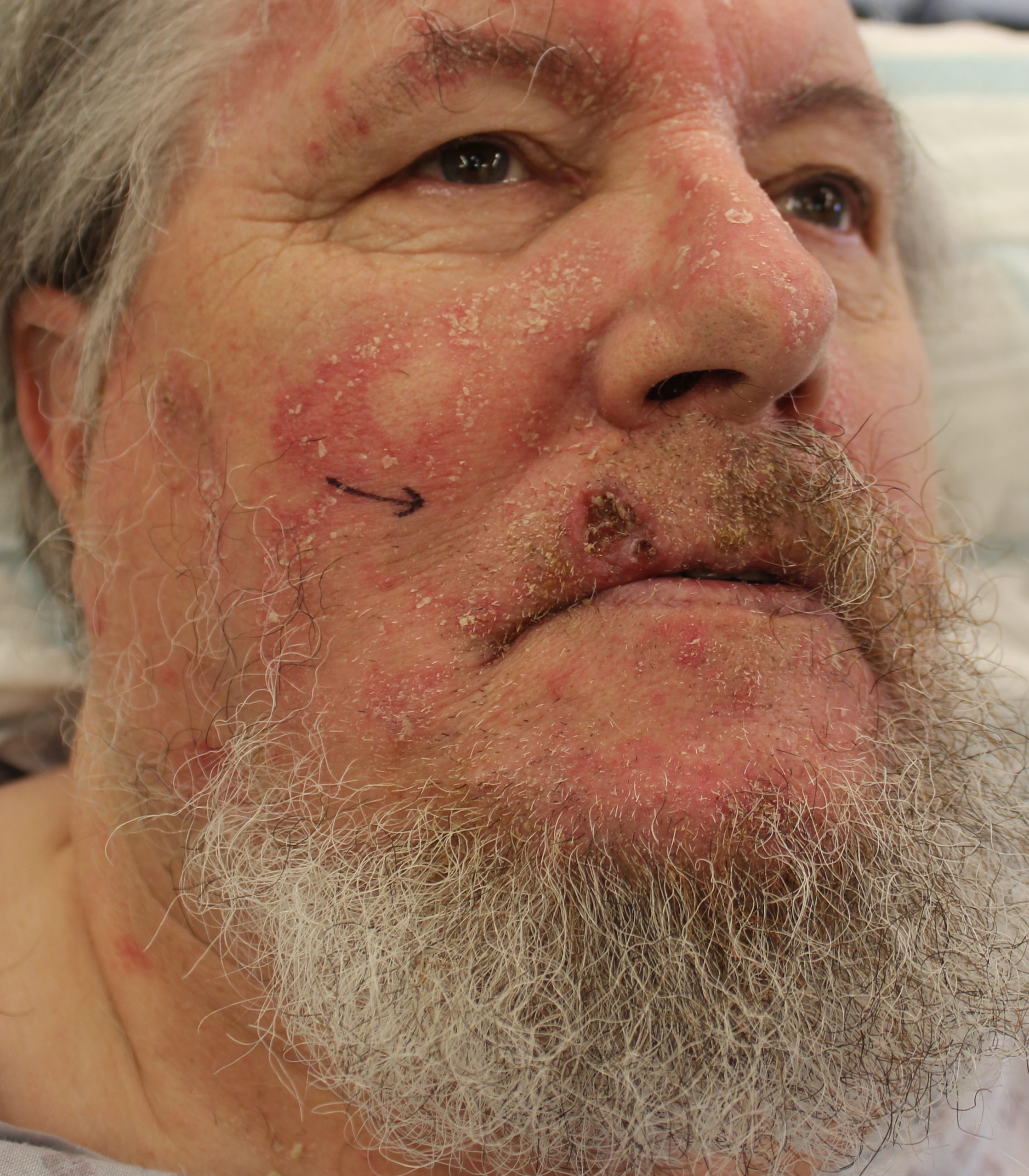 Abbe flap upper lip reconstruction patient 1 before AP view scaled