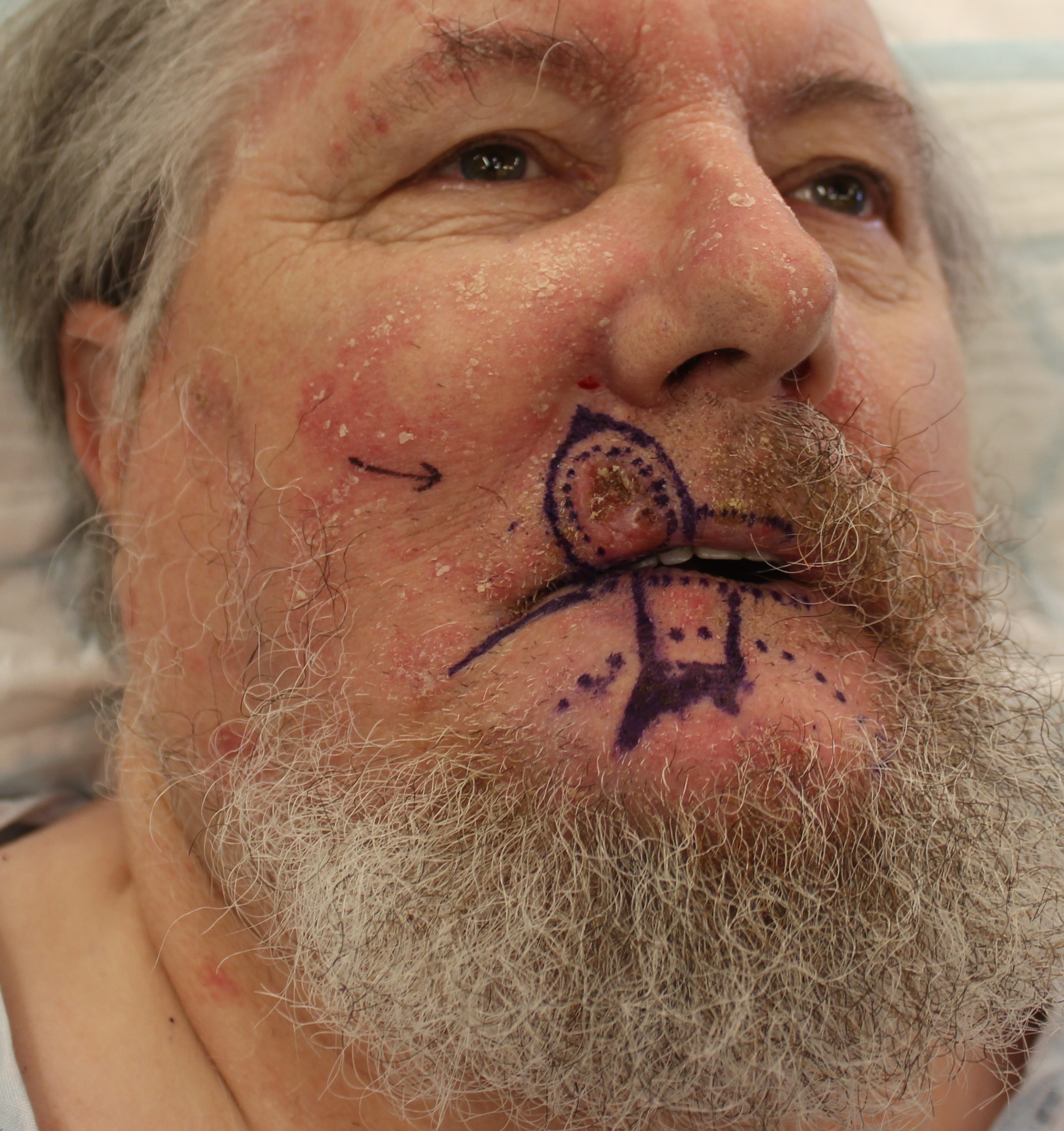 Abbe flap upper lip reconstruction patient 1 flap design scaled