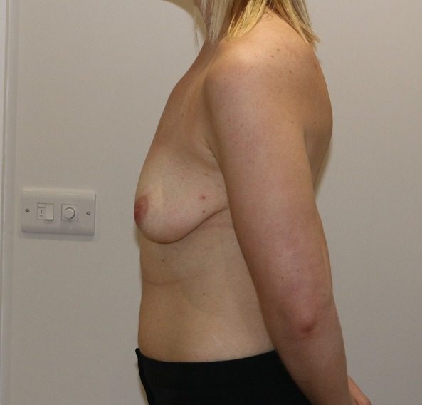 Breast augmentation mastopexy before left lateral