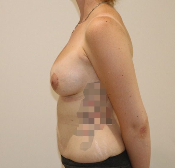 Breast enlargement 1 after left lateral