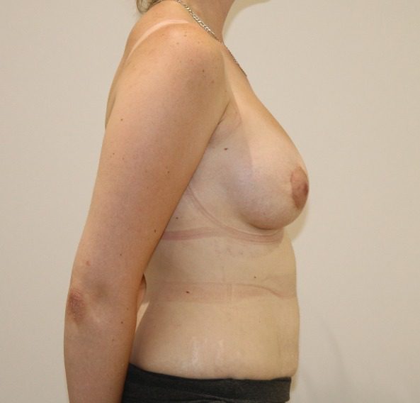 Breast enlargement 1 after right lateral