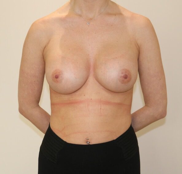 Breast enlargement after AP view 4