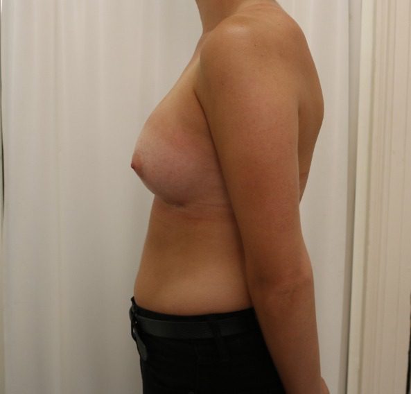 Breast enlargement after left lateral 1