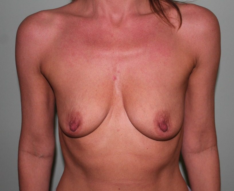 Breast enlargement before AP view 1