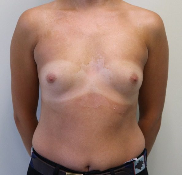 Breast enlargement before AP view 2