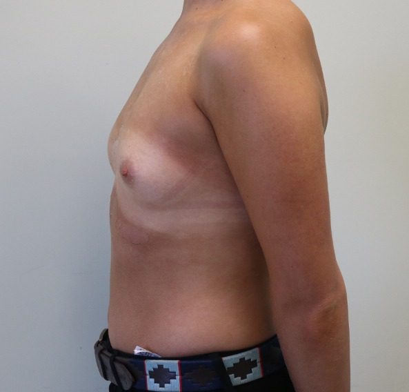 Breast enlargement before left lateral 1