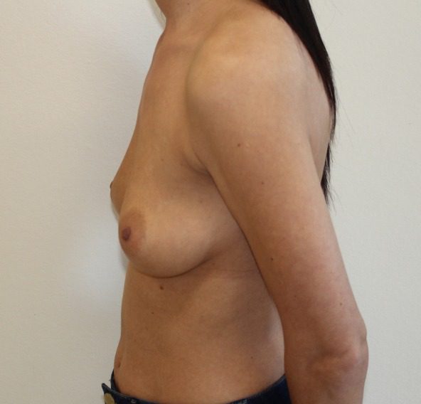 Breast enlargement before left lateral