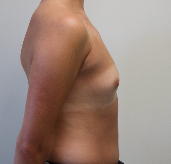 Breast enlargement before right lateral 2