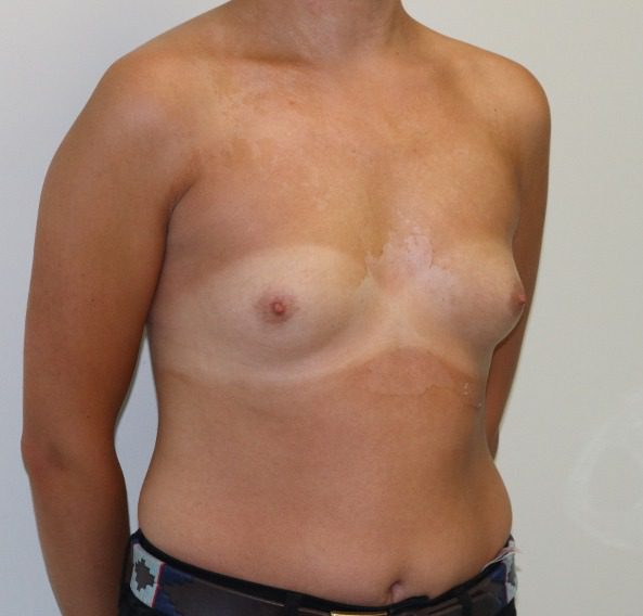 Breast enlargement before right oblique 2
