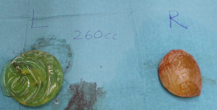 Breast implant capsules