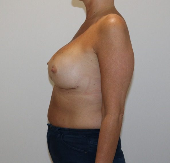 Capsular contracture surgery after left lateral