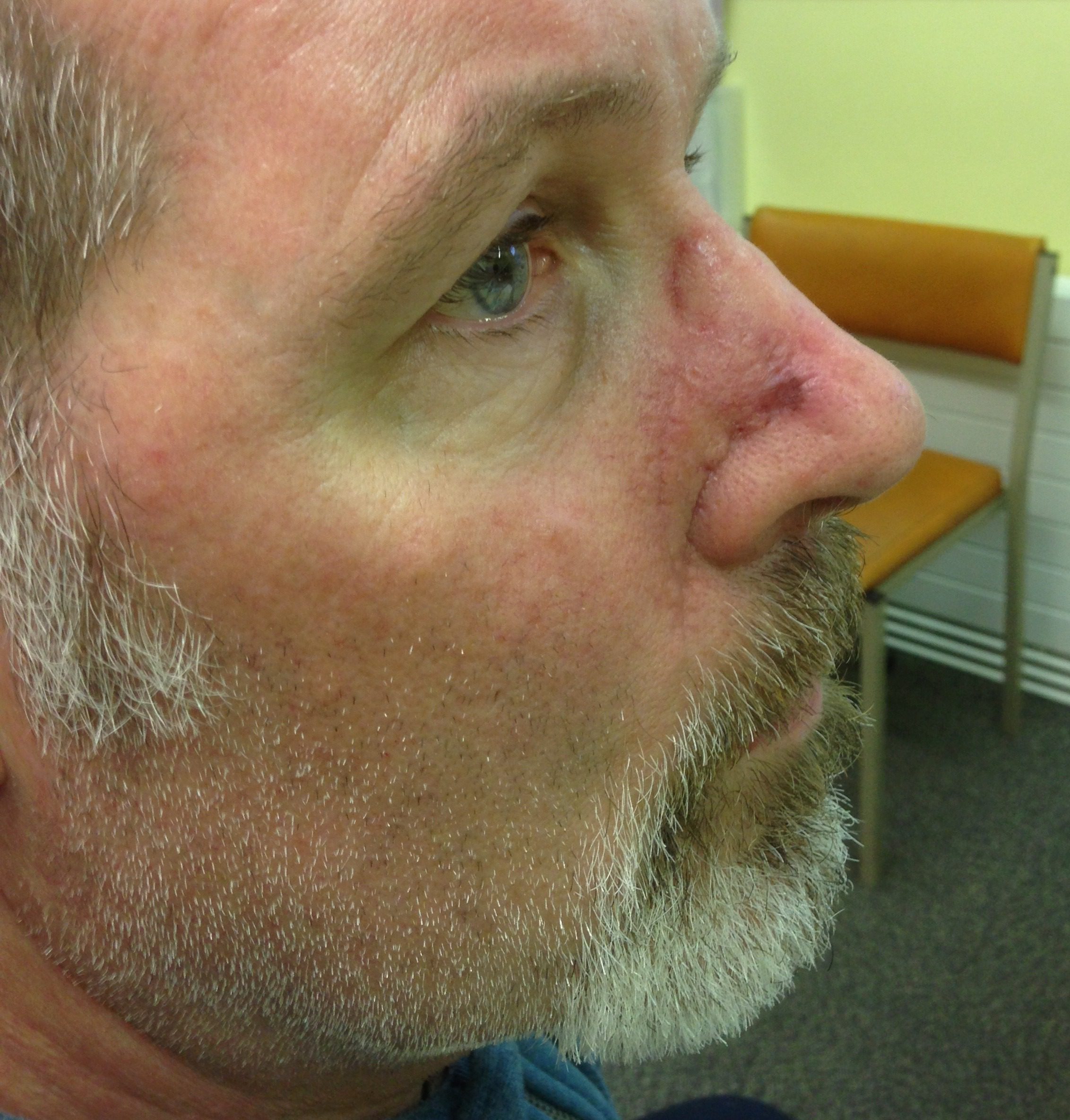 Facial artery perforator flap patient 1 after