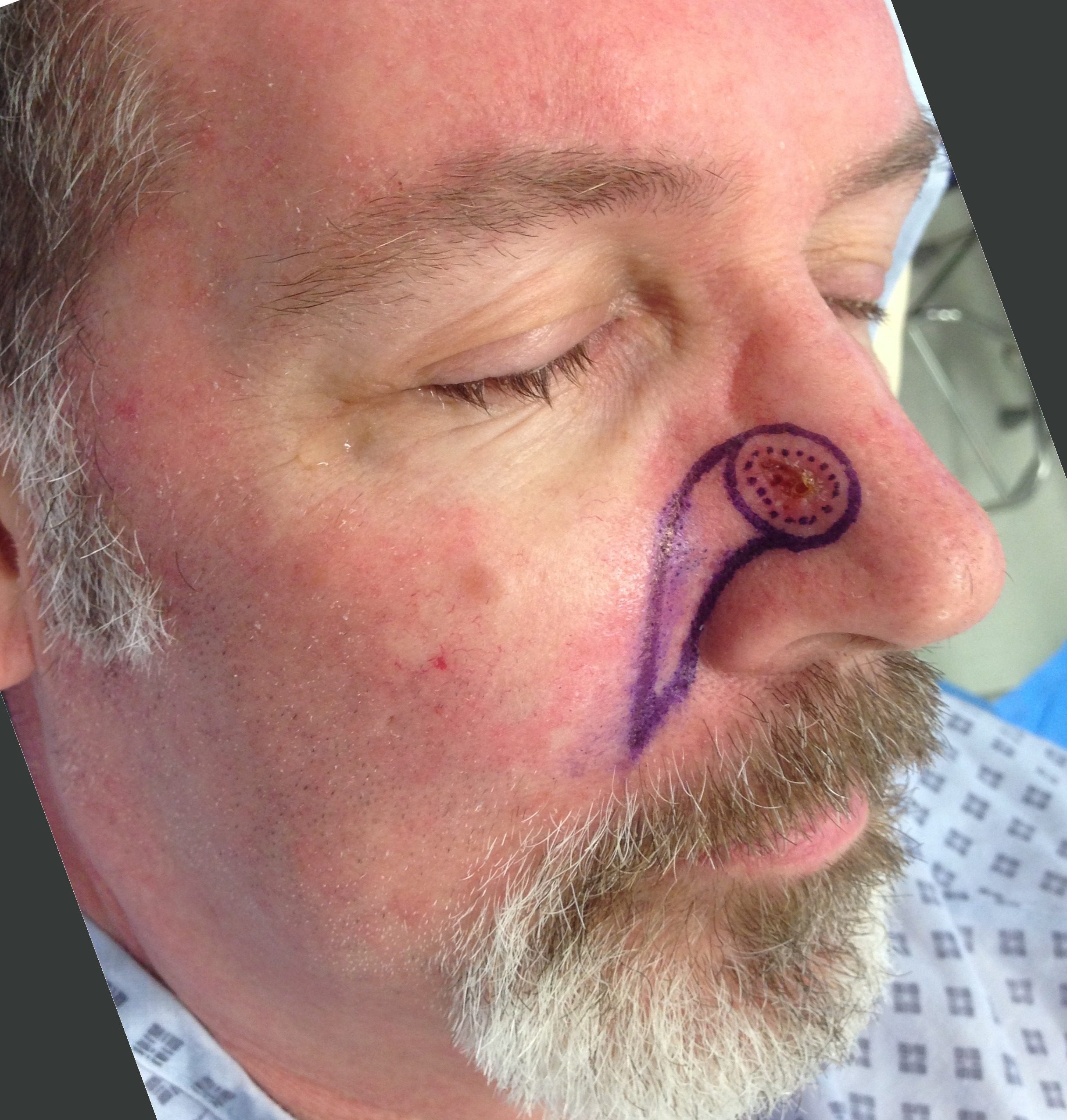 Facial artery perforator flap patient 1 before