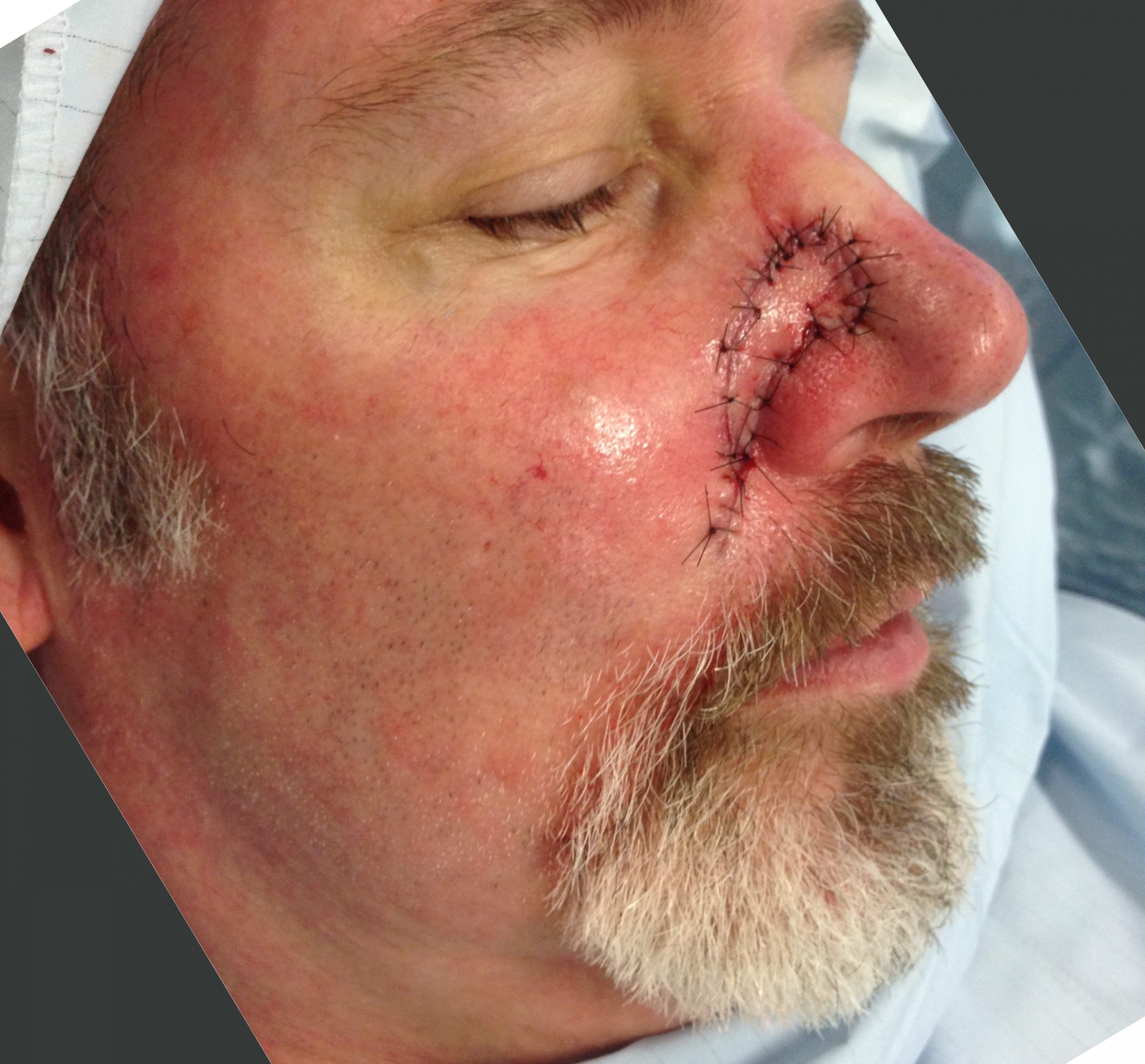 Facial artery perforator flap patient 1 immediate scaled