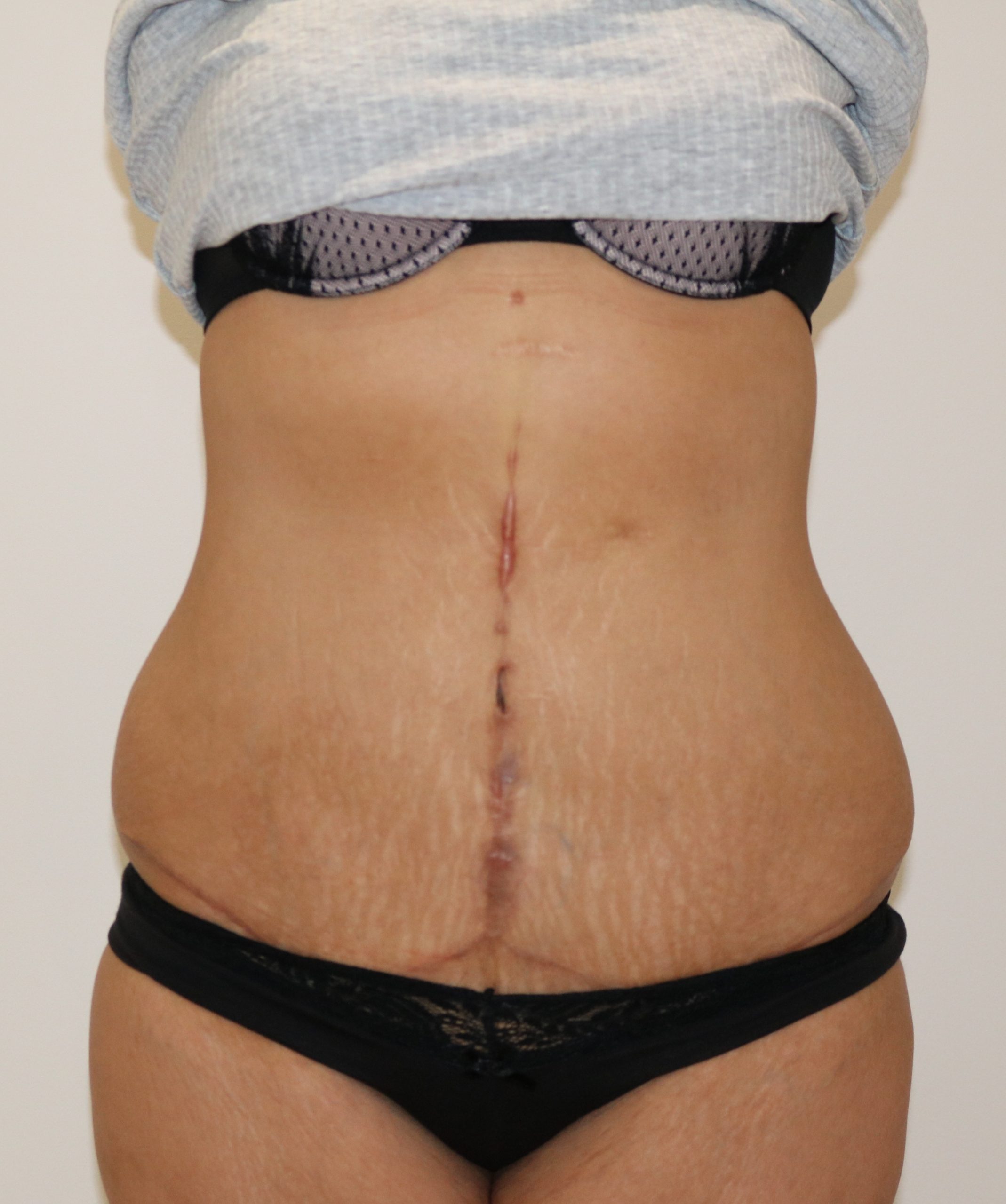 Fleur de lis abdominoplasty after AP view scaled