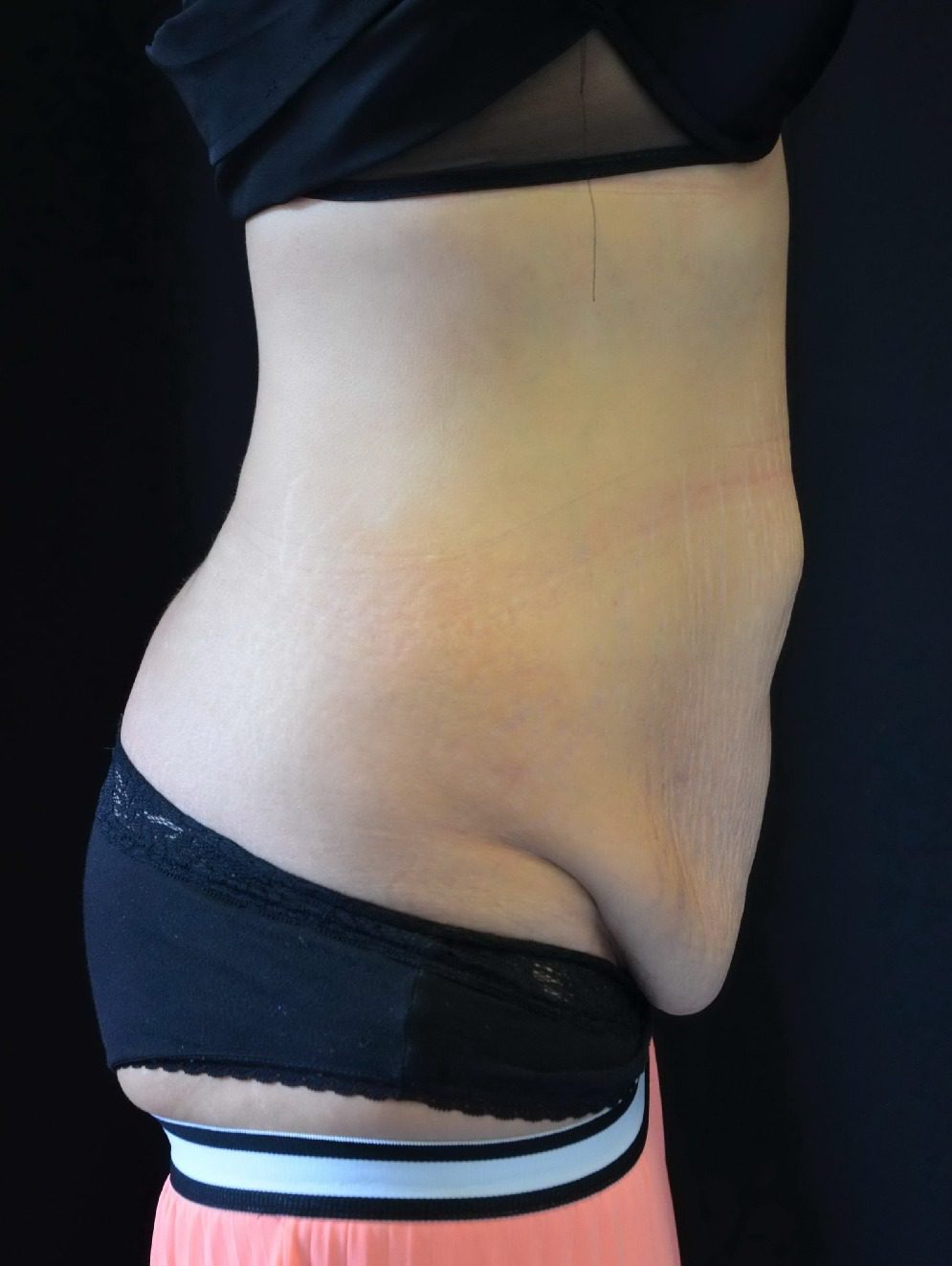 Fleur de lis abdominoplasty before lateral
