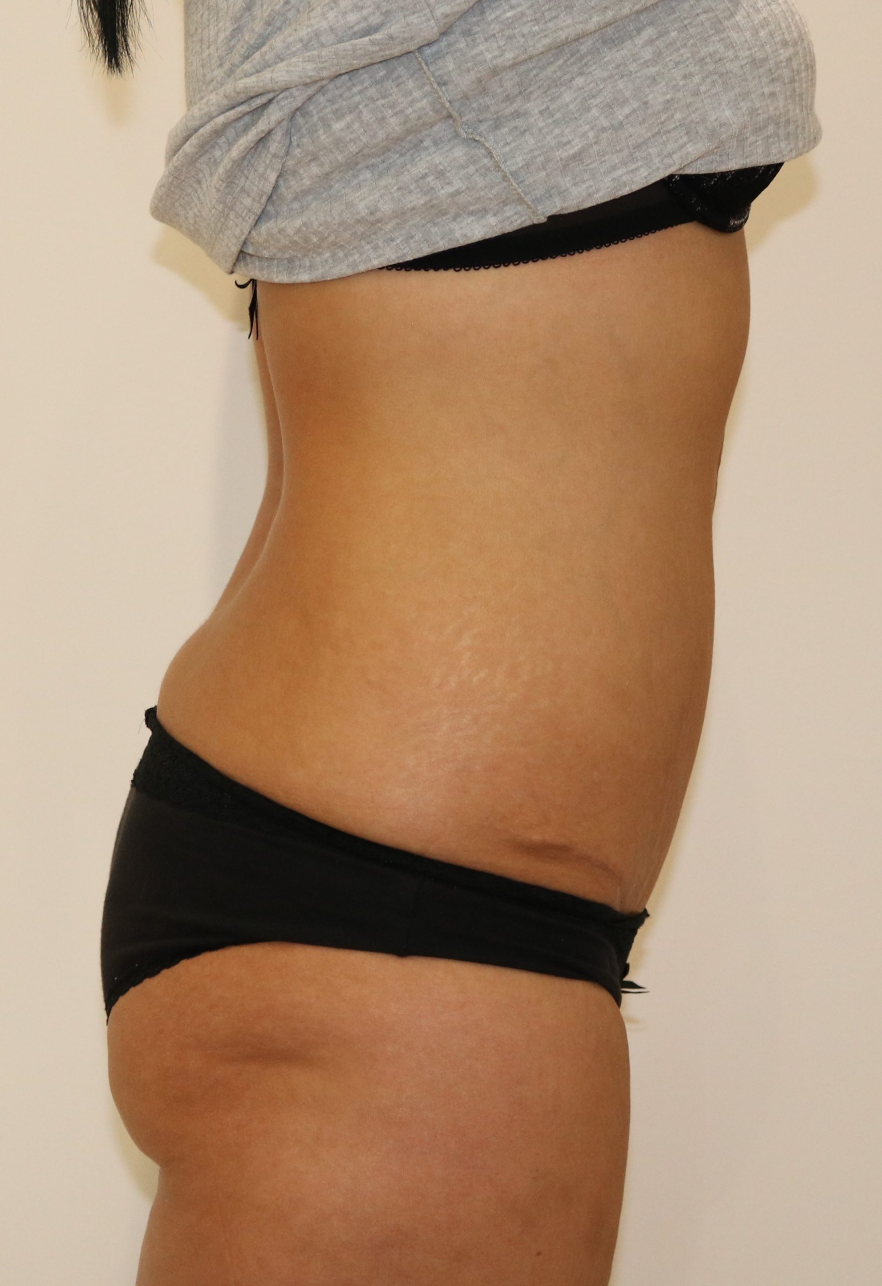 Fleur de lis abdoninoplasty after lateral scaled