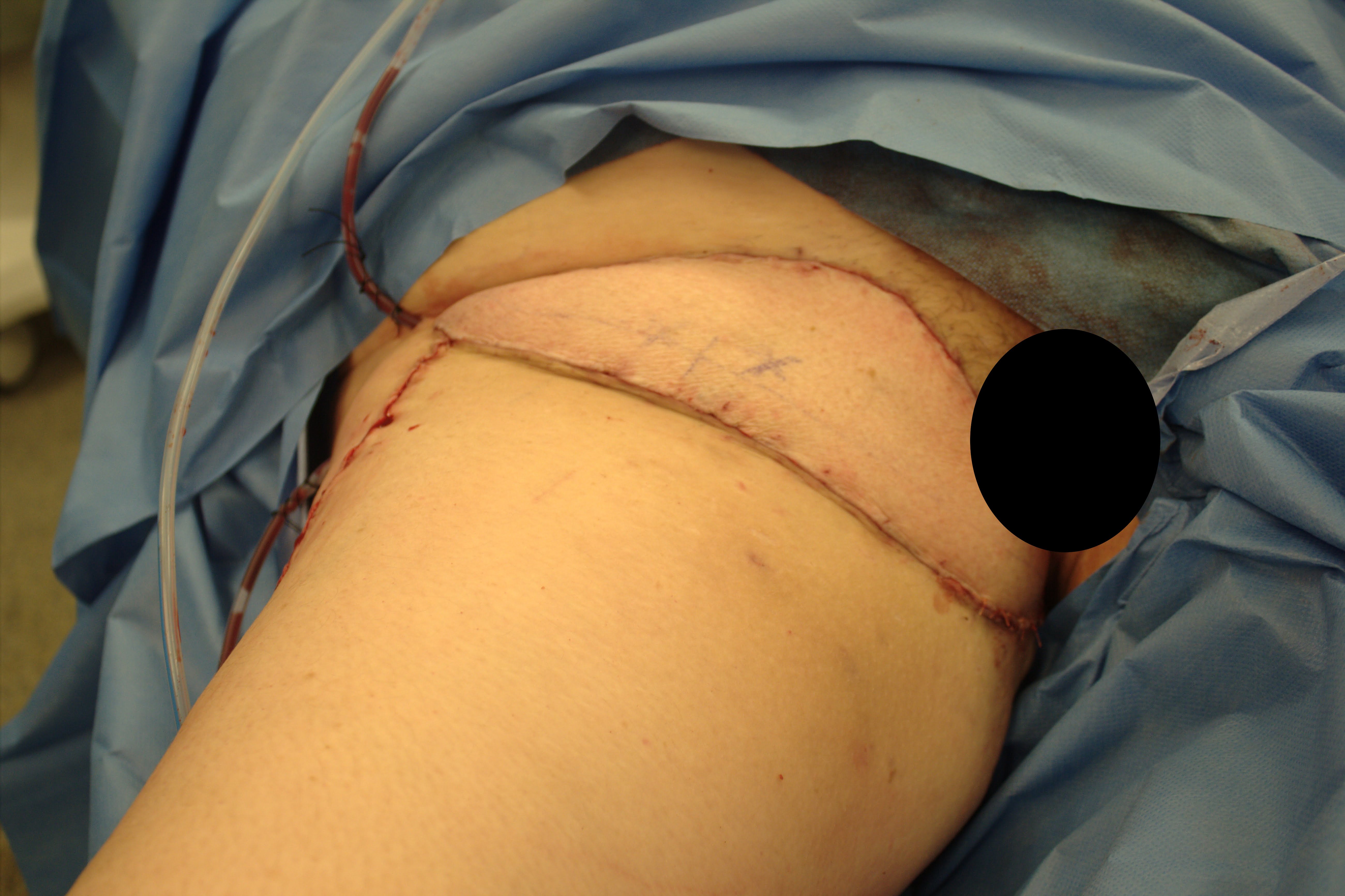 Groin hidradenitis supprativa after pedicled ALT flap reconstruction