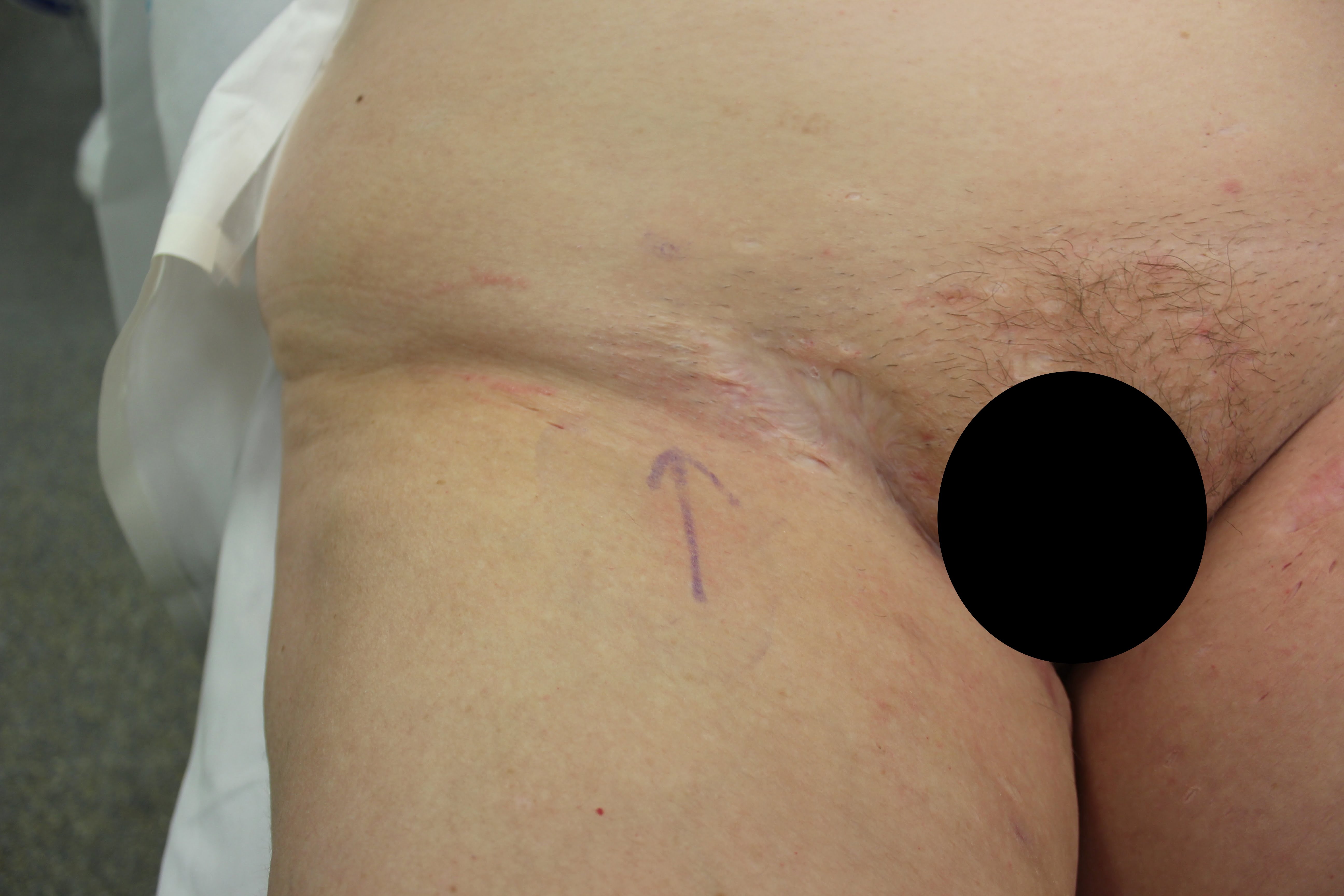 Groin hidradenitis supprativa before pedicled ALT flap reconstruction