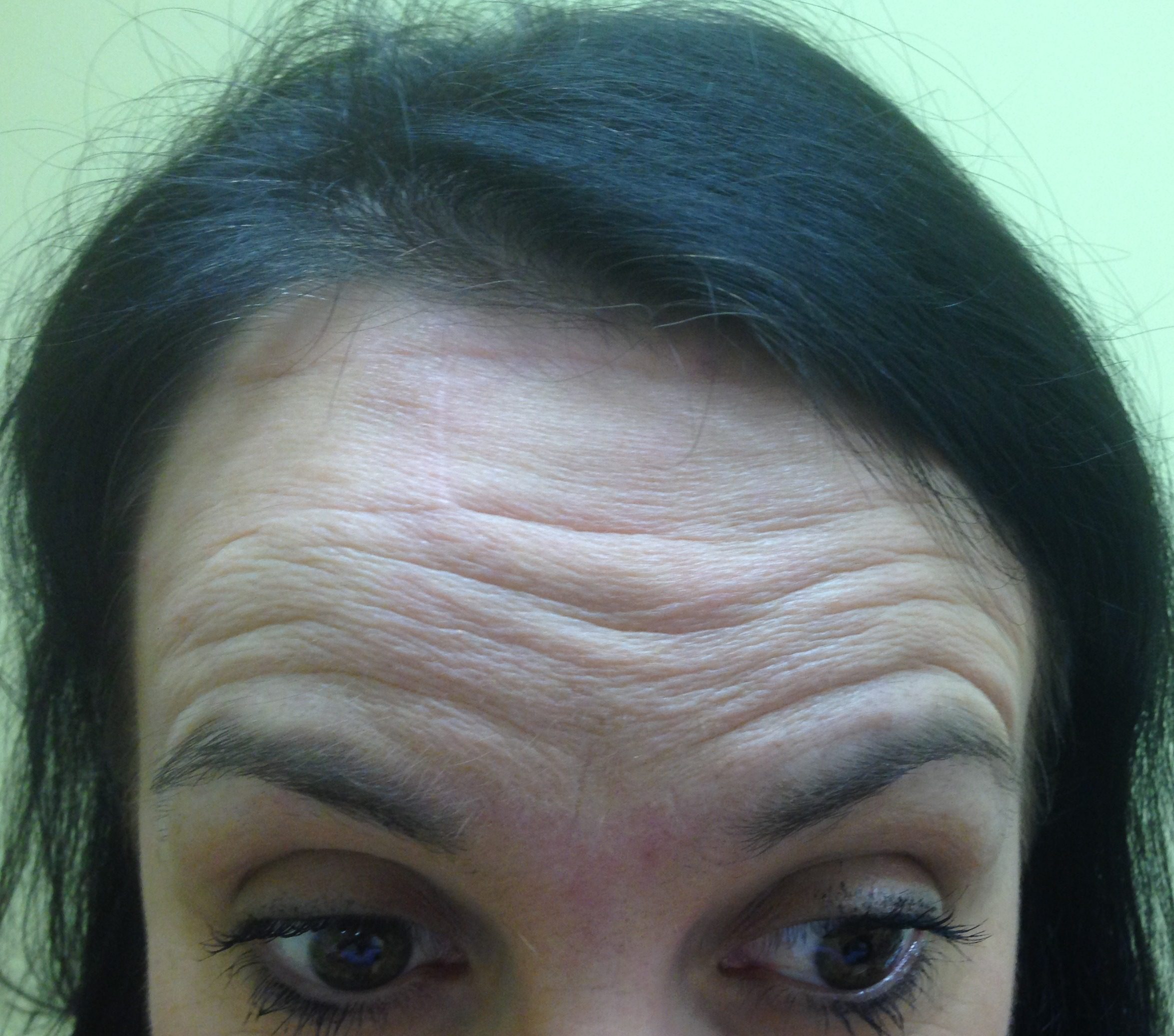 H flap patient 1 after frontalis preserved