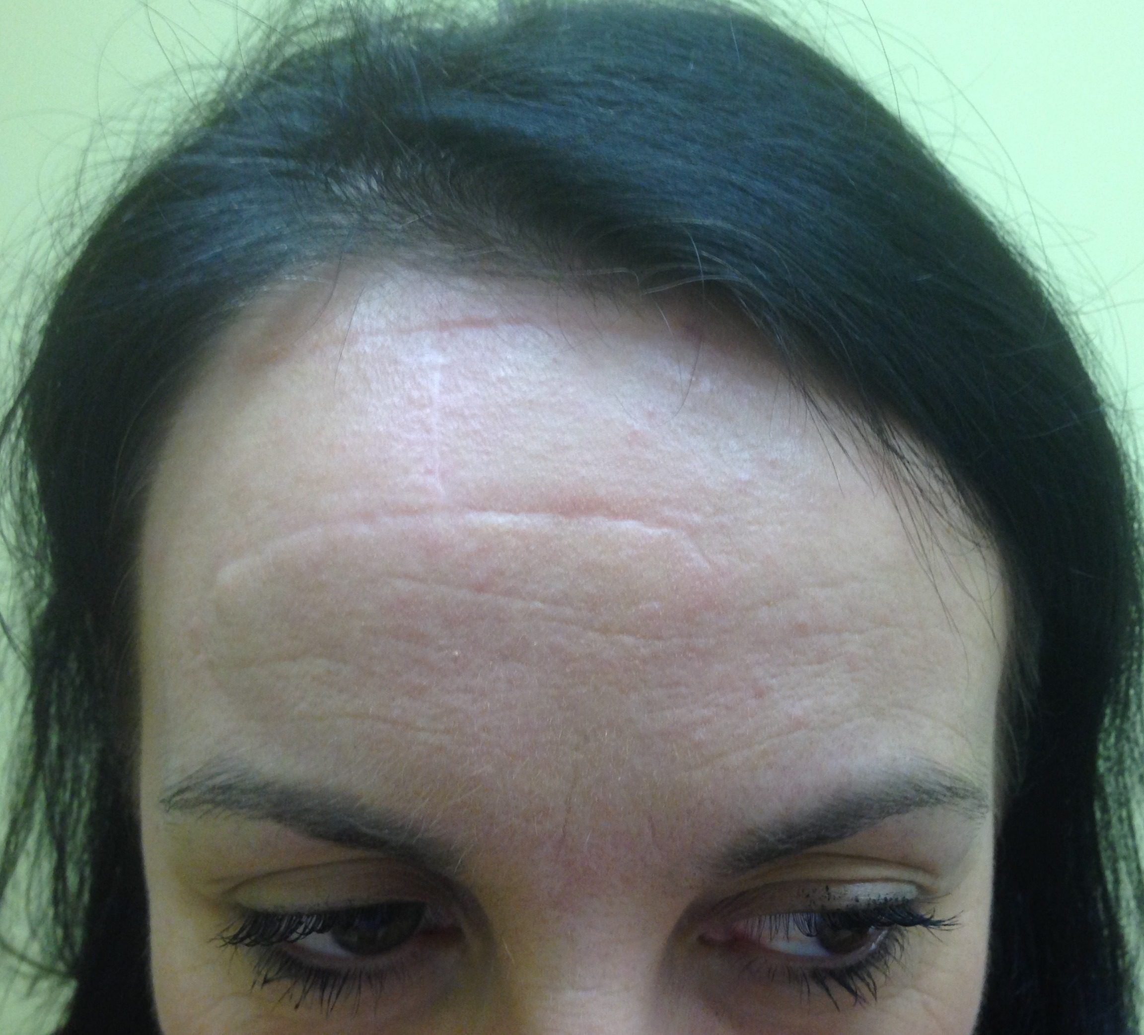 H flap patient 1 after