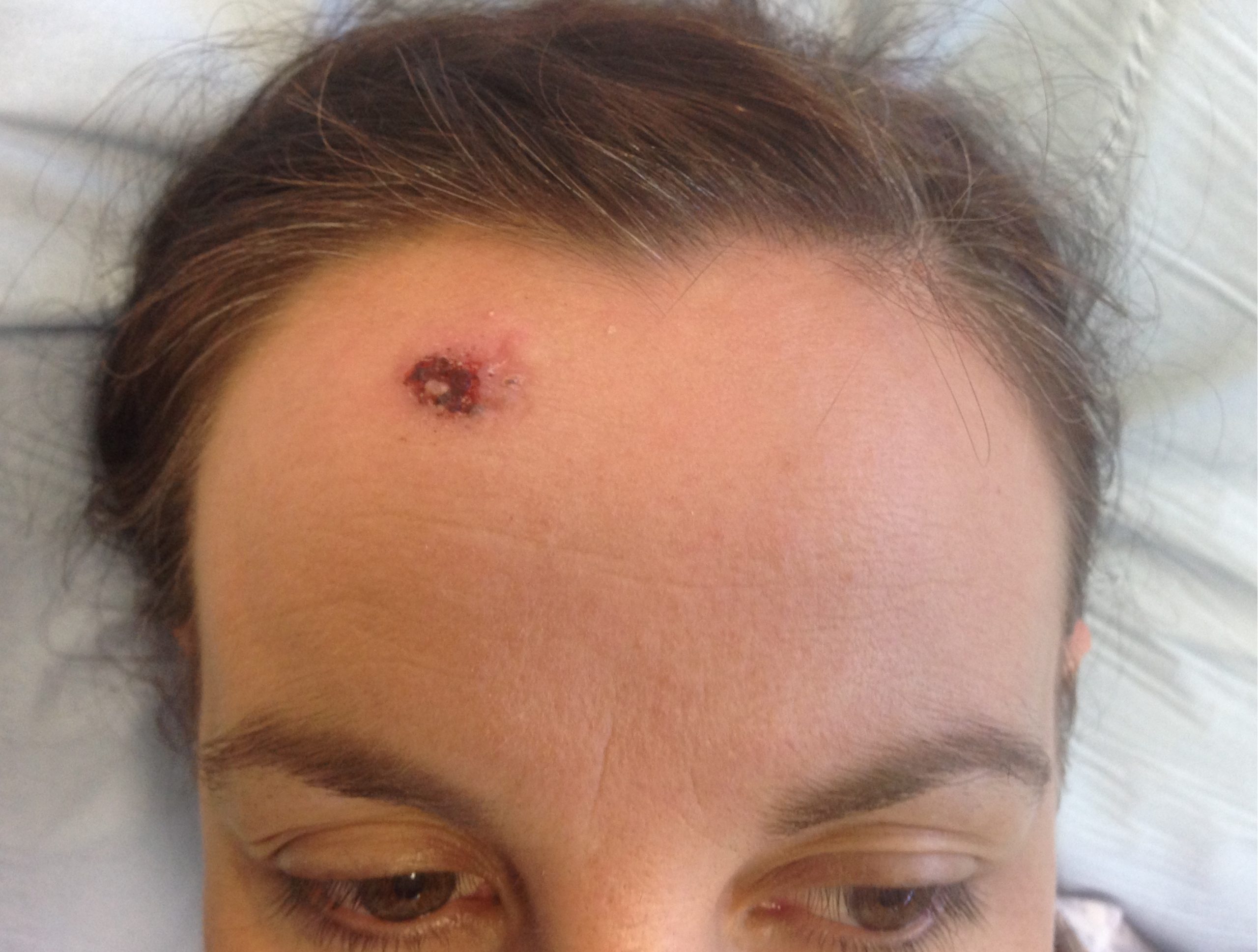 H flap patient 1 before scaled