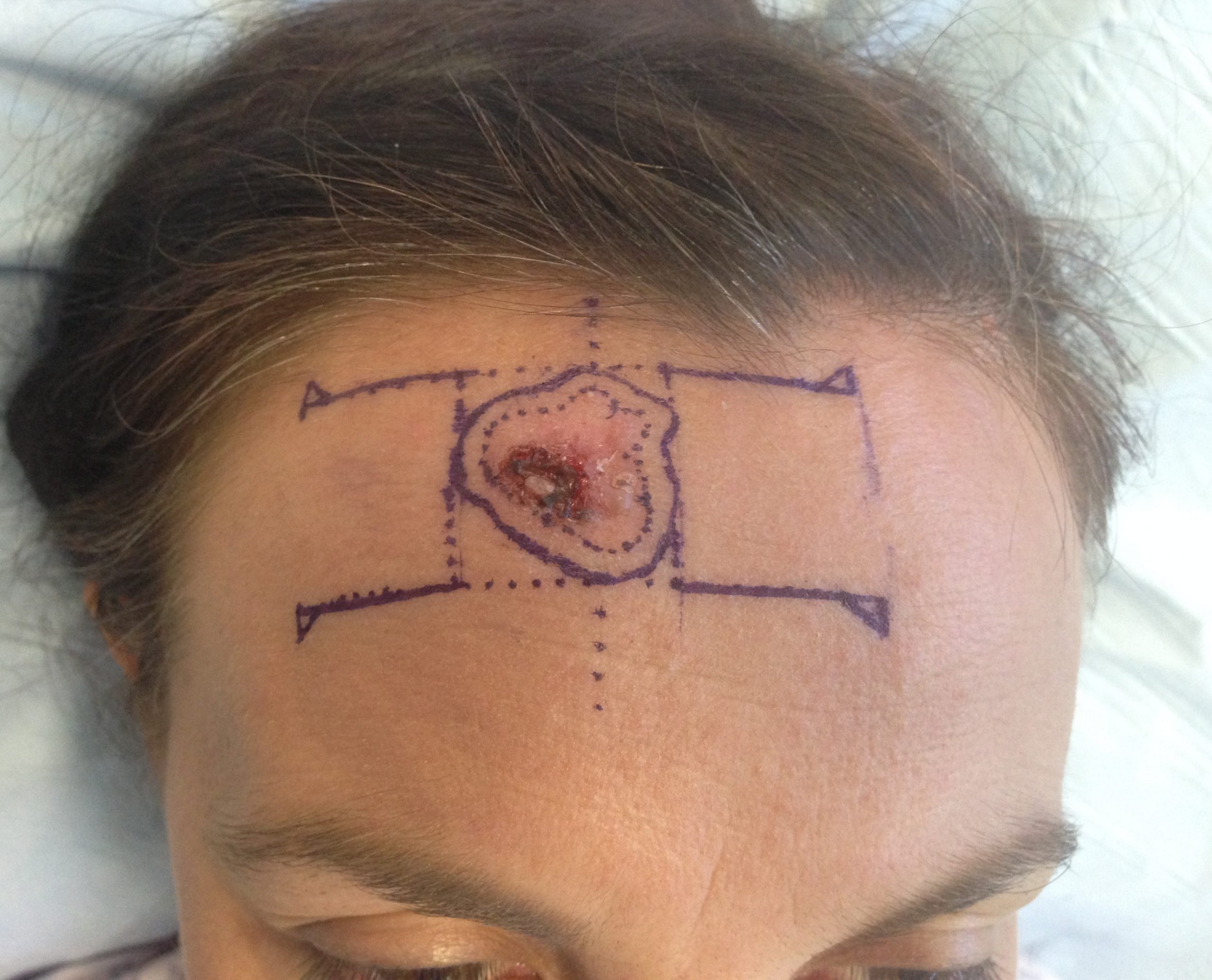 H flap patient 1 flap design scaled