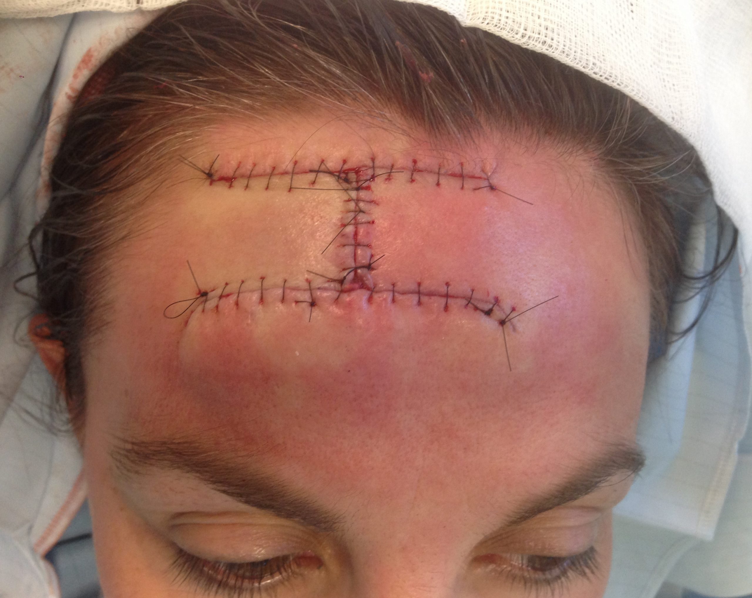 H flap patient 1 immediate appearance scaled