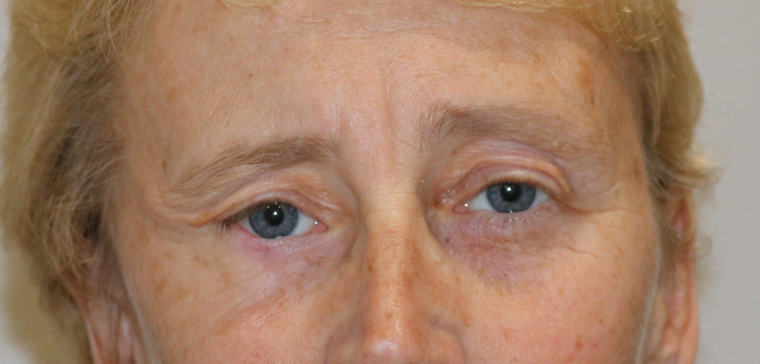 Hughes flap lower eyelid reconstruction after AP view e 1478965154944 scaled