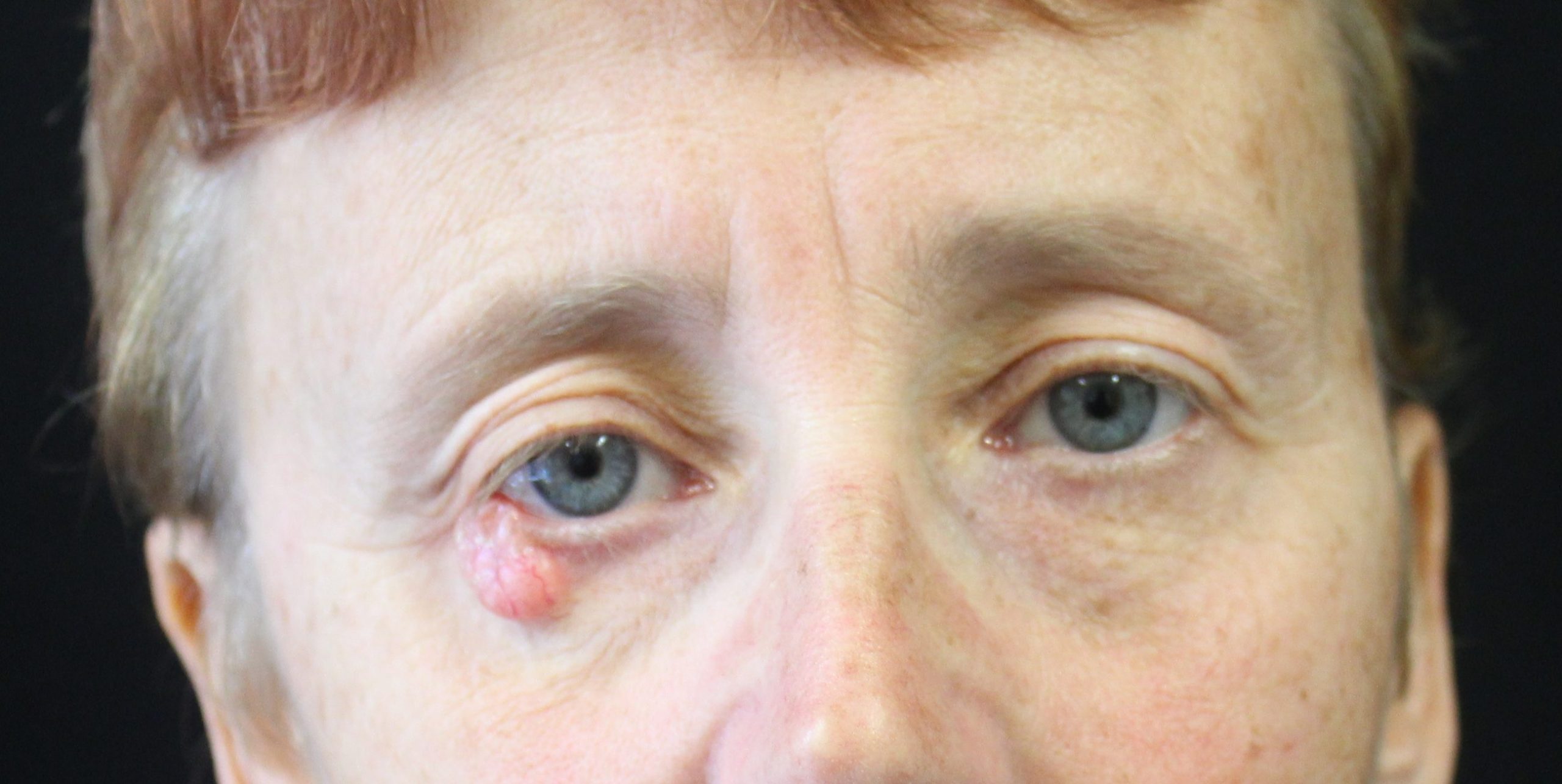 Hughes flap lower eyelid reconstruction before AP view e 1478964540845 scaled