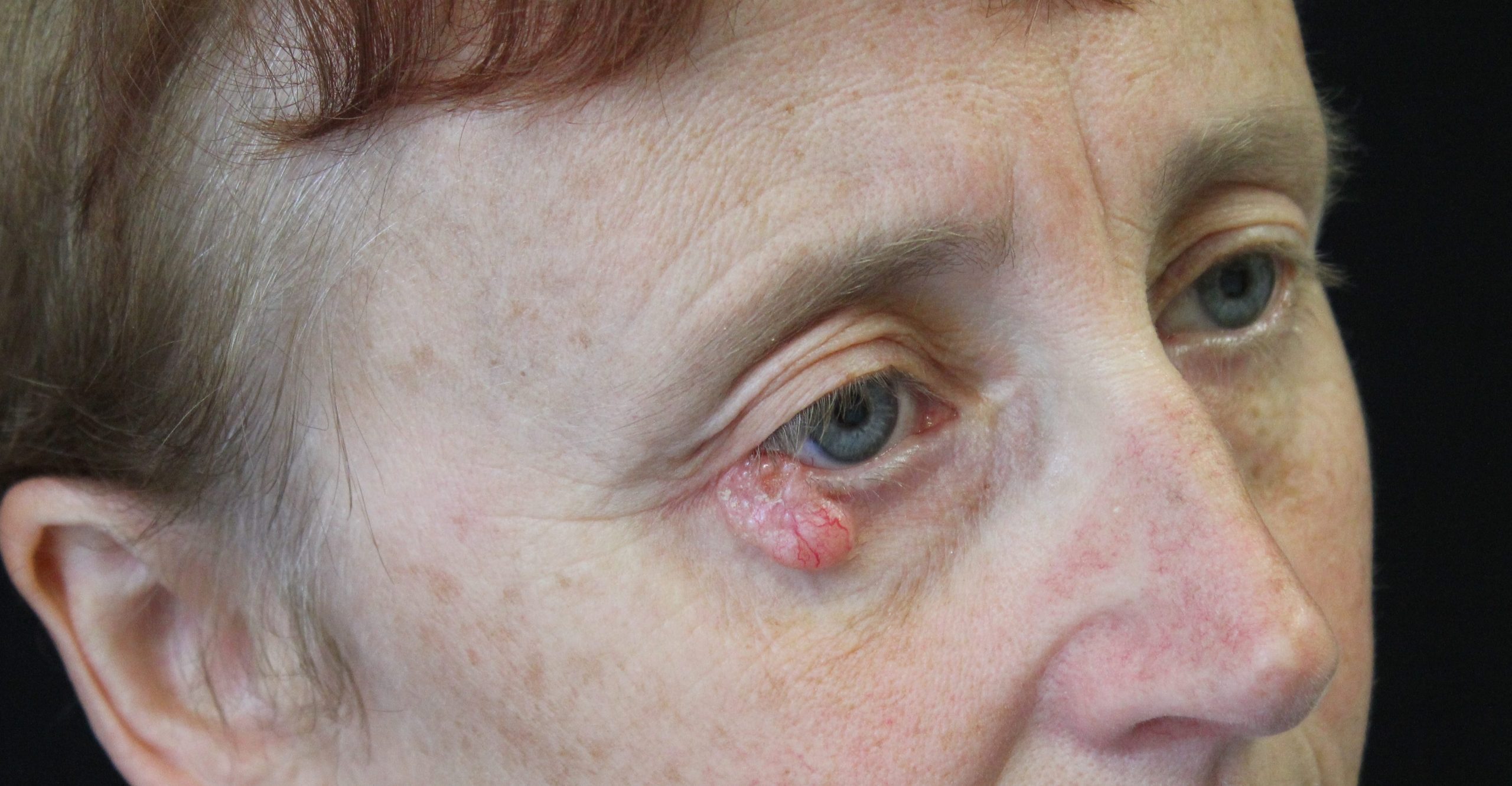 Hughes flap lower eyelid reconstruction before rightoblique e 1478964717754 scaled