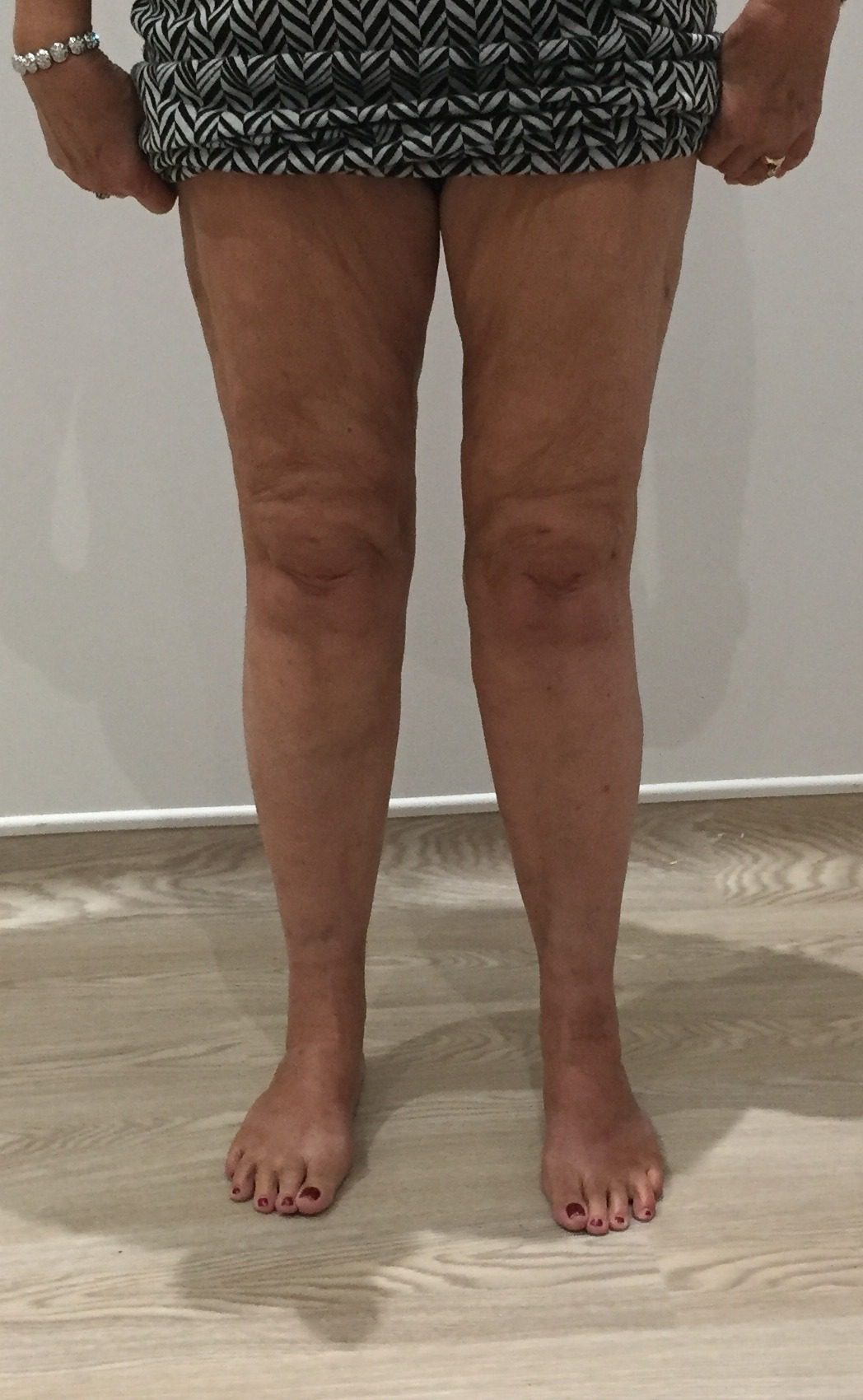 Lipoedema liposuction type II after AP view
