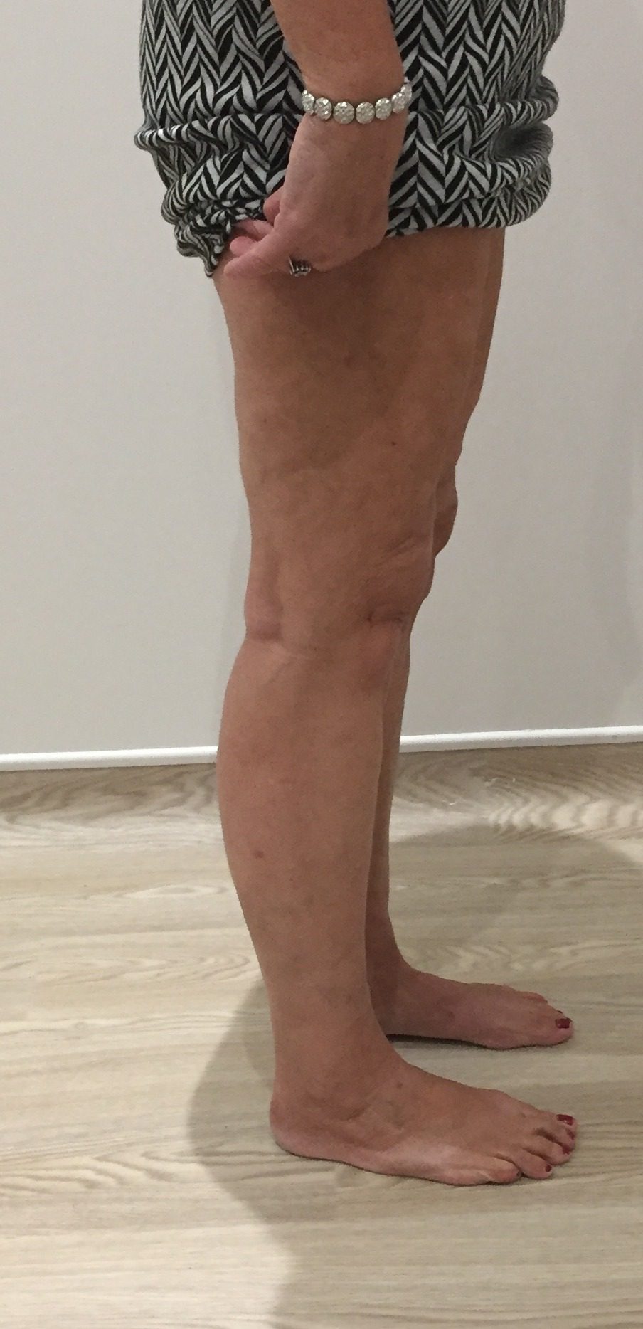 Lipoedema liposuction type II after right lateral