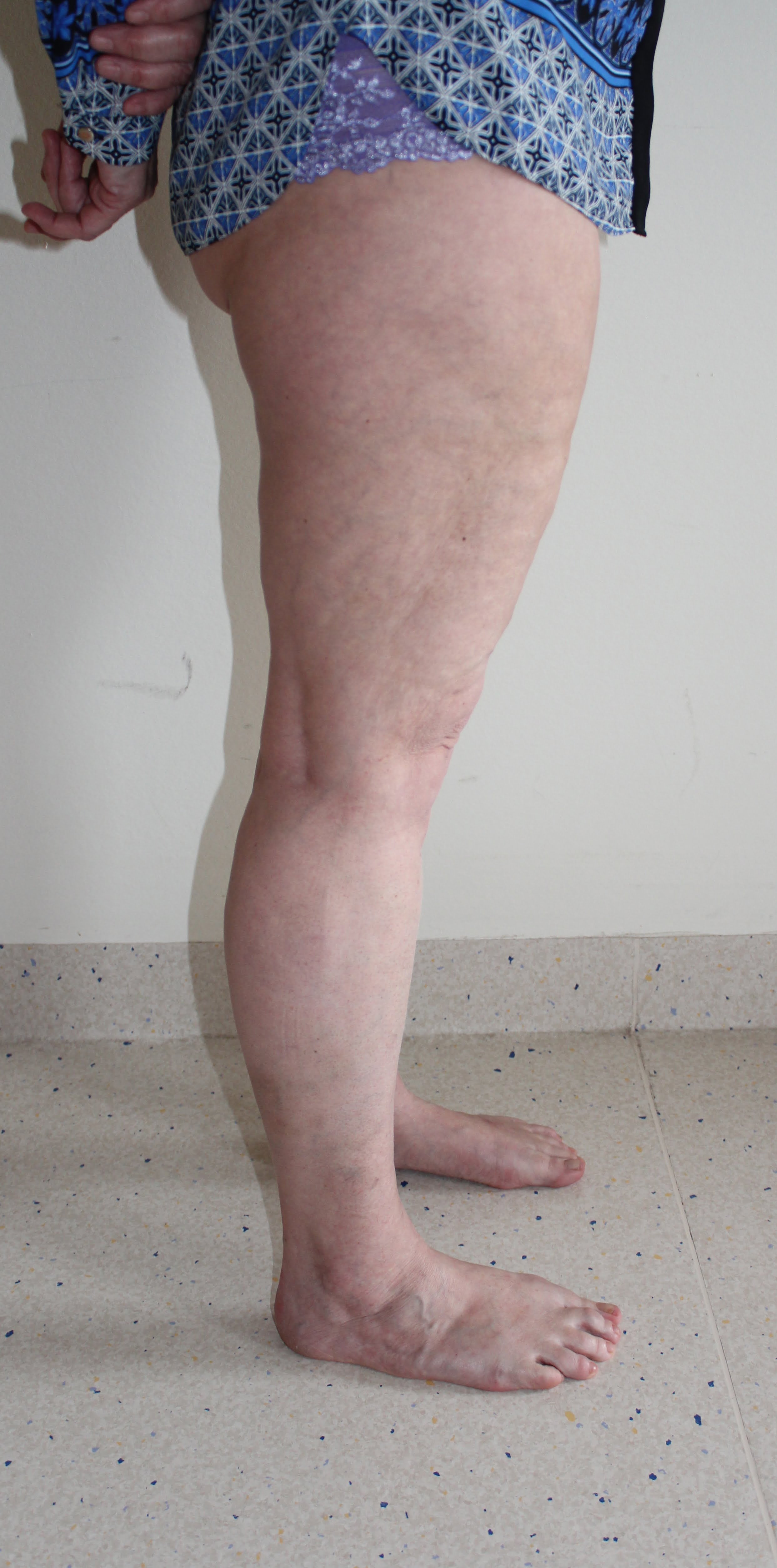 Lipoedema liposuction type II before right lateral
