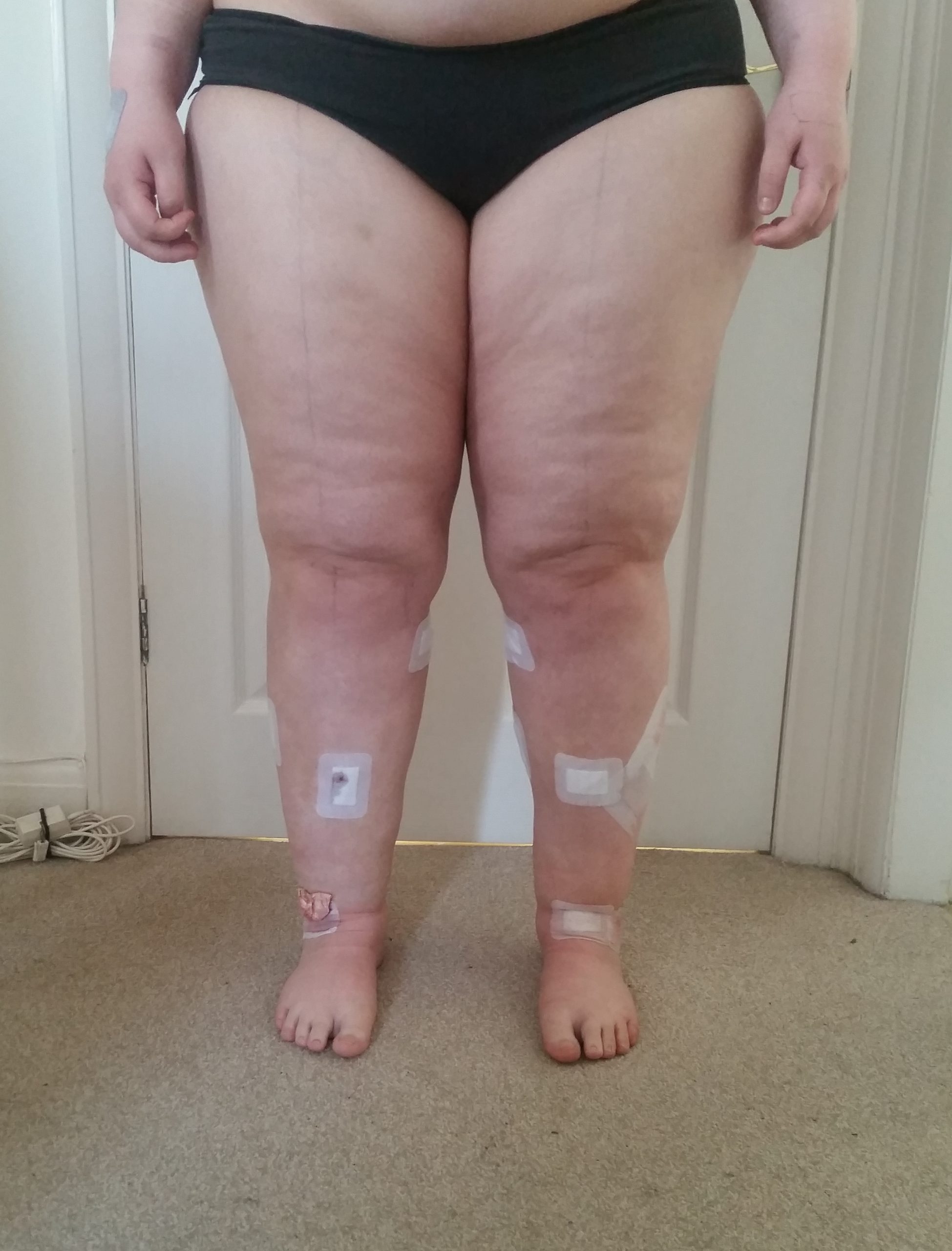 Lower limb lipoedema liposuction patient 1 day 2 scaled
