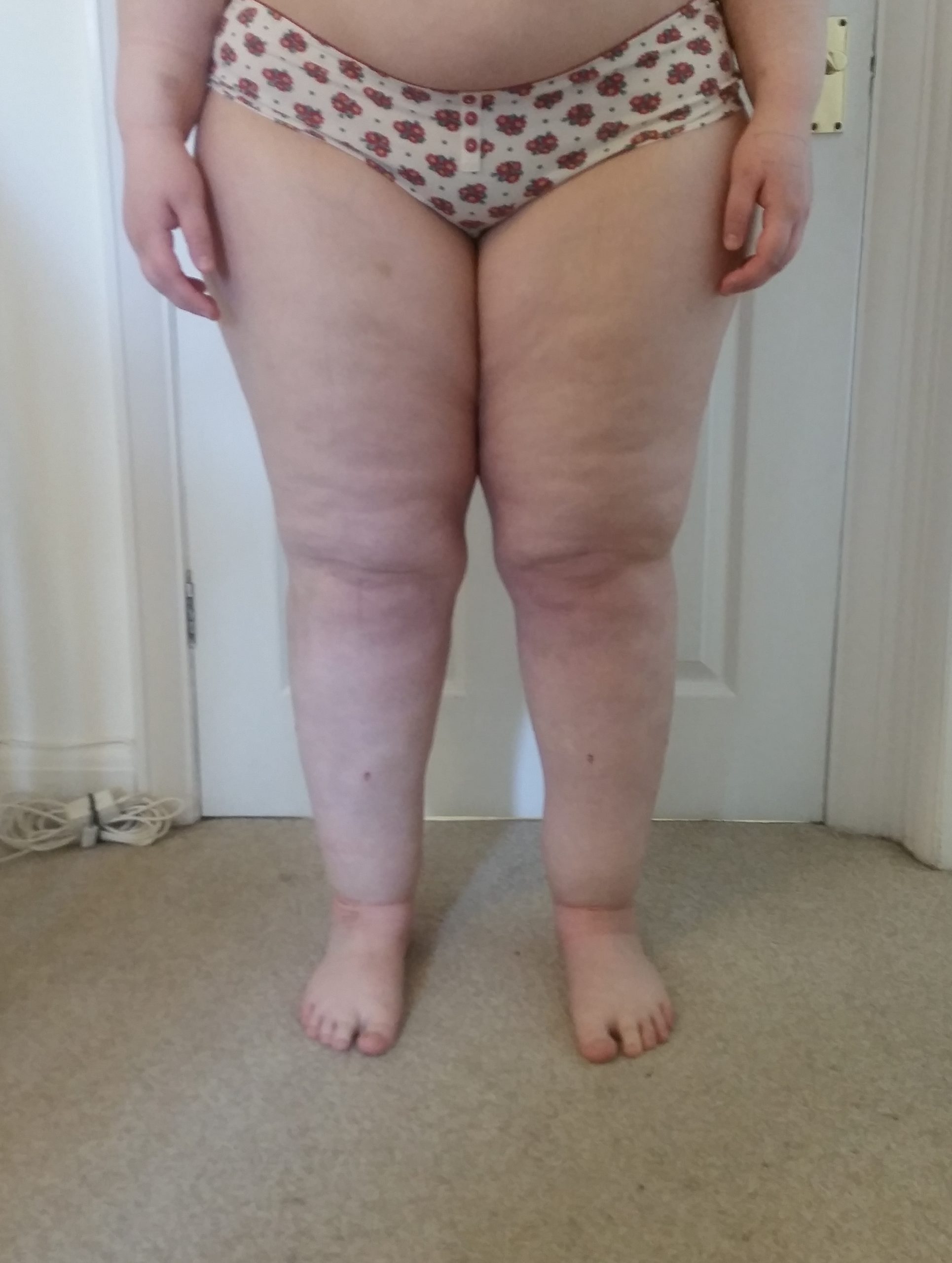 Lower limb lipoedema liposuction patient 1 day 3 1 scaled