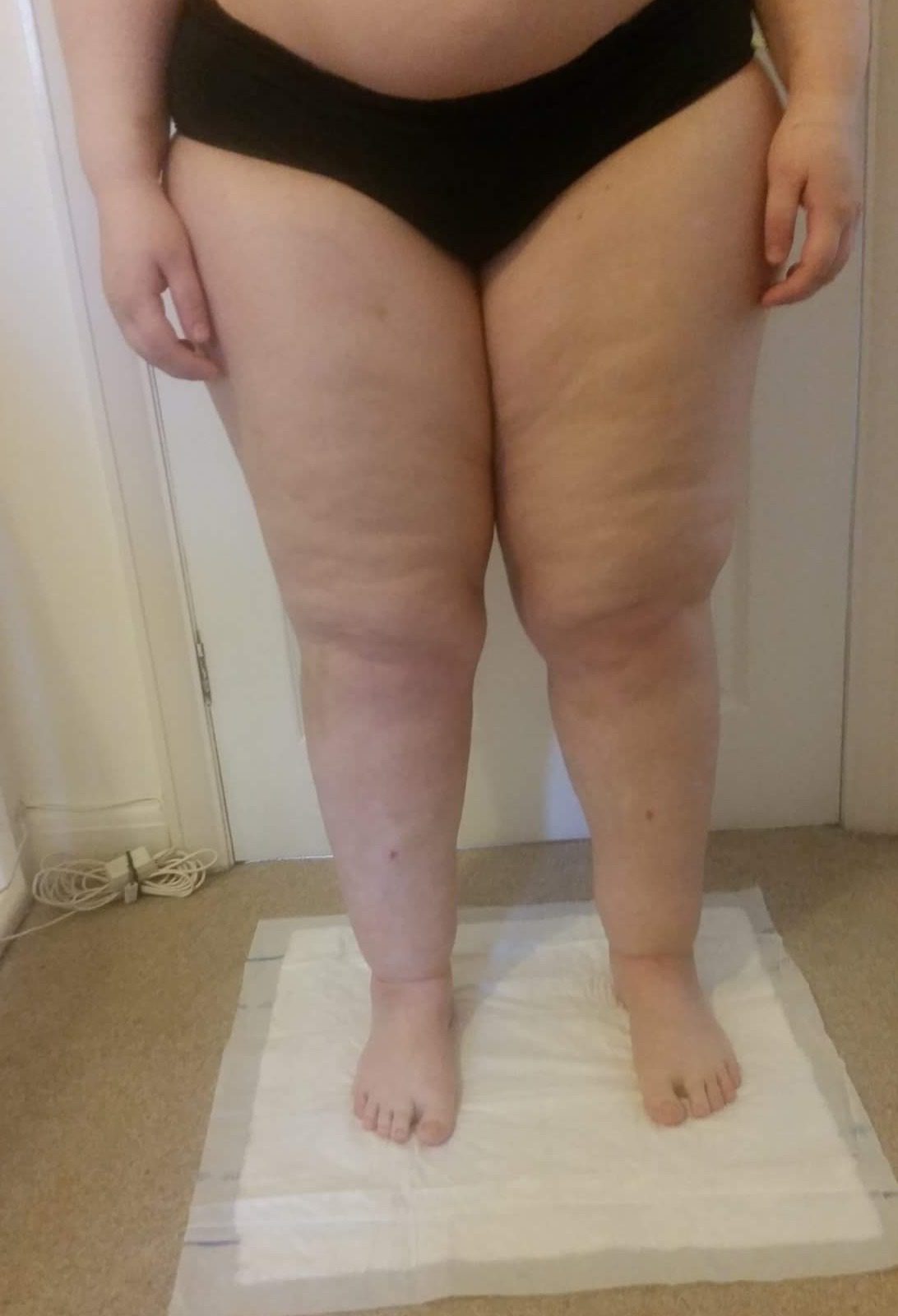 Lower limb lipoedema liposuction patient 1 day 4 1