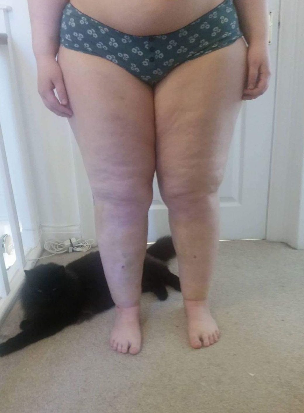 Lower limb lipoedema liposuction patient 1 day 5 1