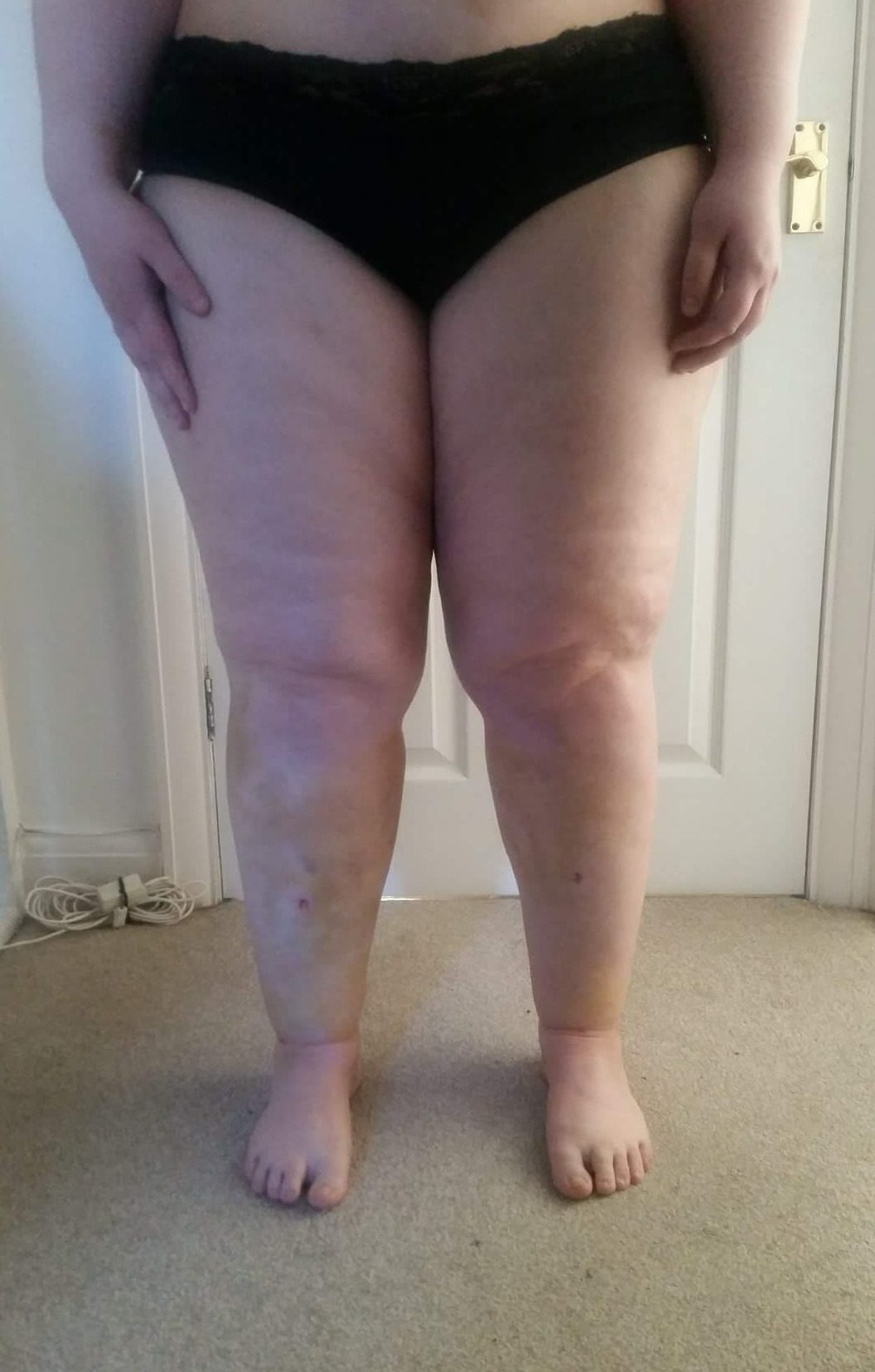 Lower limb lipoedema liposuction patient 1 day 6 1